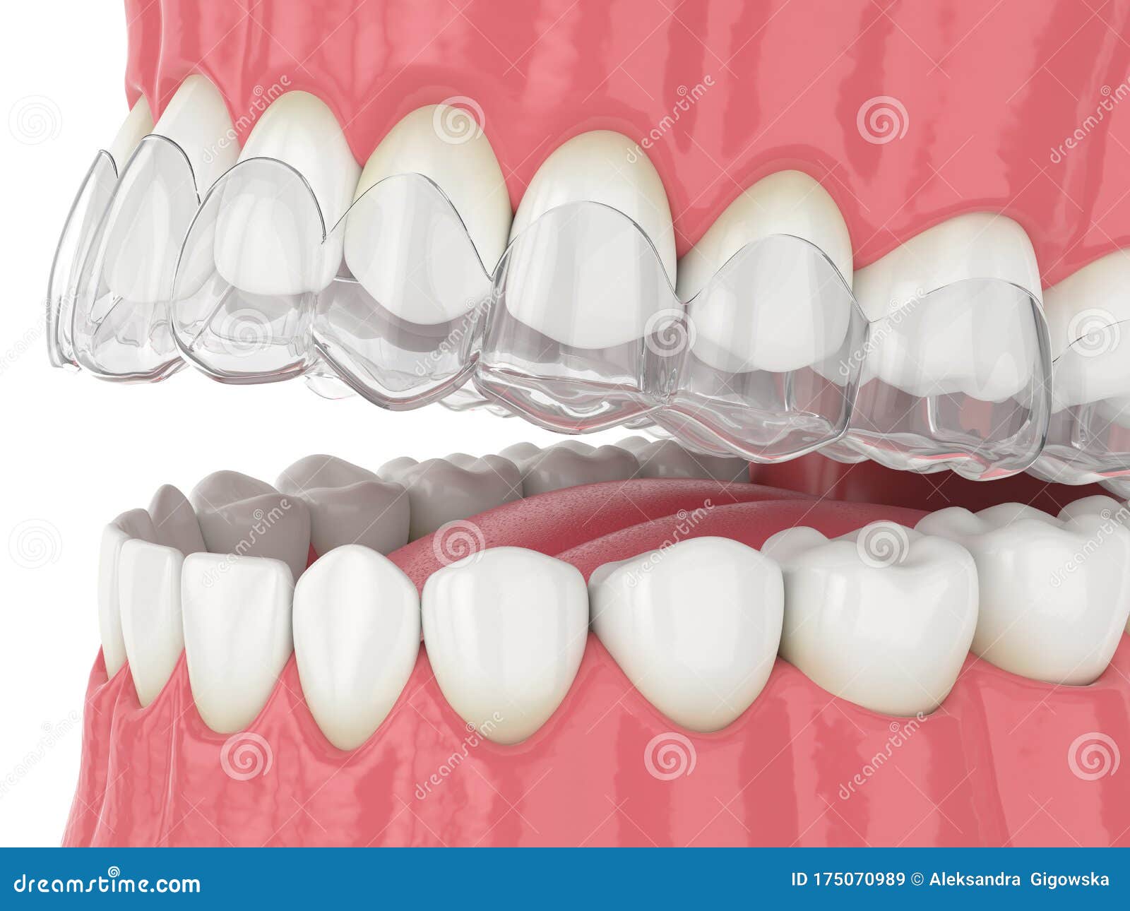 3d Render of Jaw with Invisalign Removable Retainer Stock Illustration