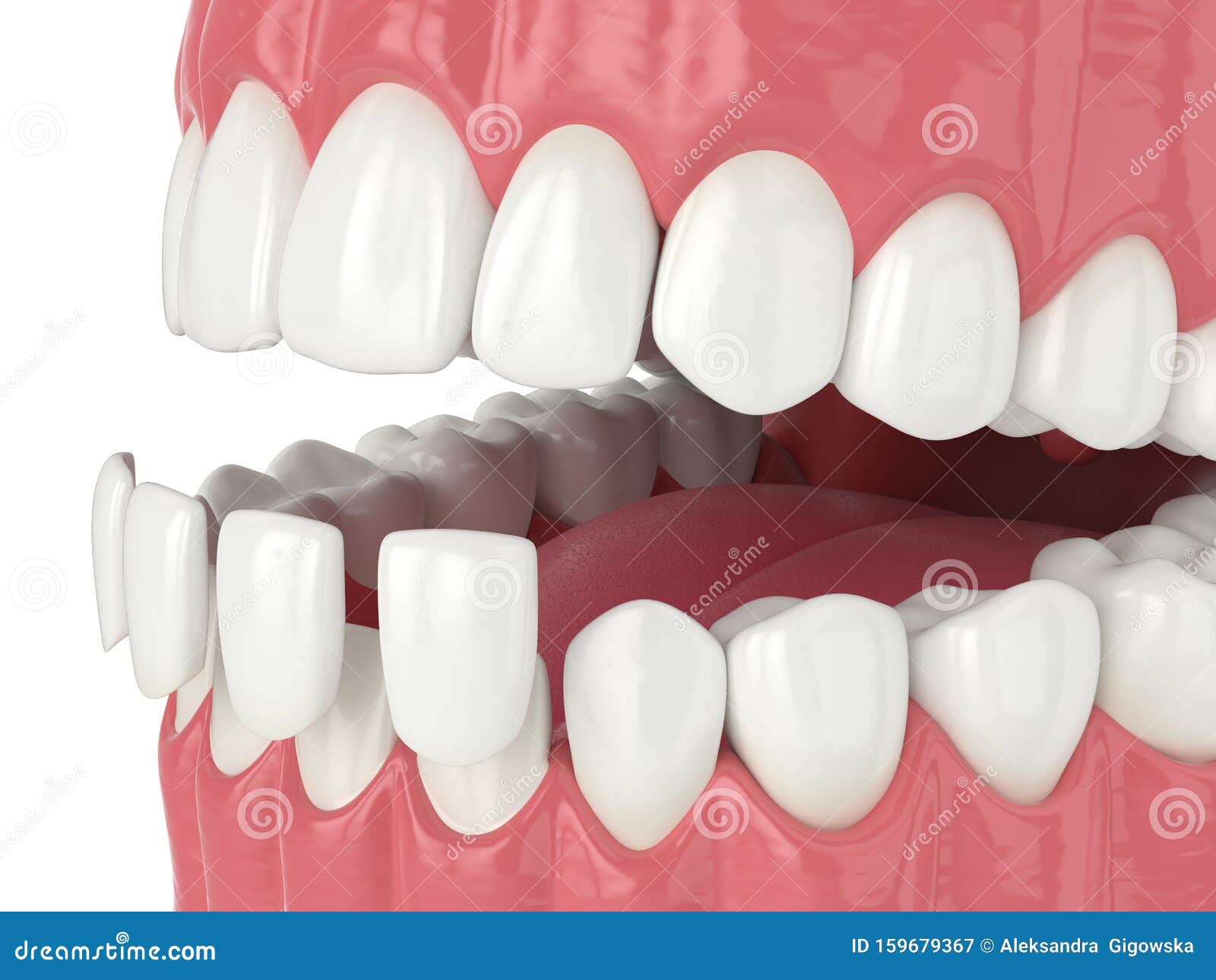 3d Render of Jaw with Lower Veneers Stock Illustration Illustration