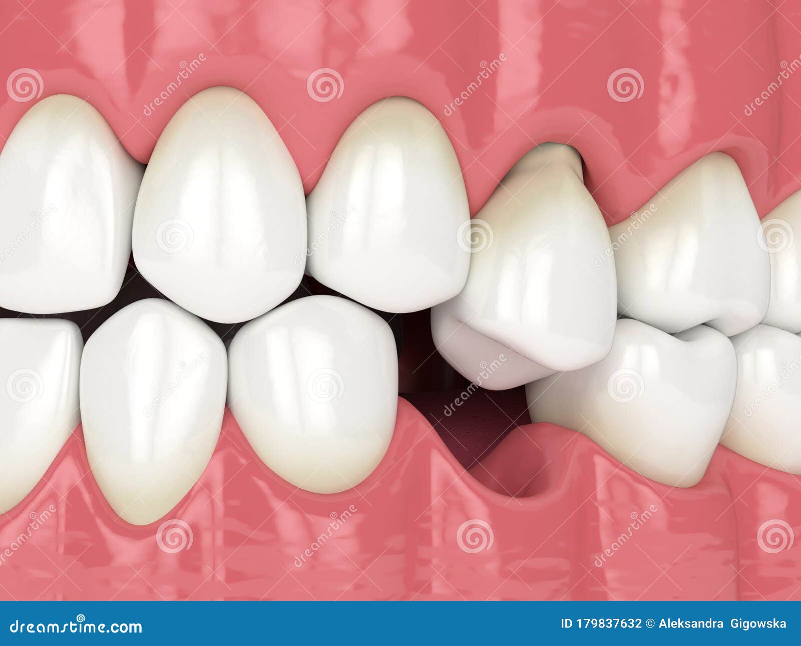 3d render of jaw with protruding tooth revealing root