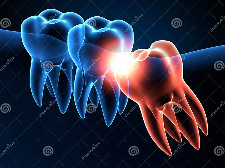 3d-render-of-jaw-x-ray-with-wisdom-mesial-impaction-stock-illustration