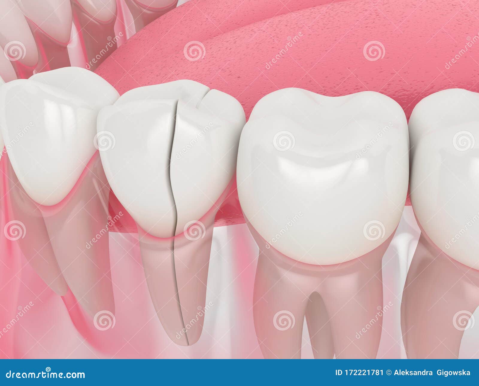 3d render of jaw with split tooth