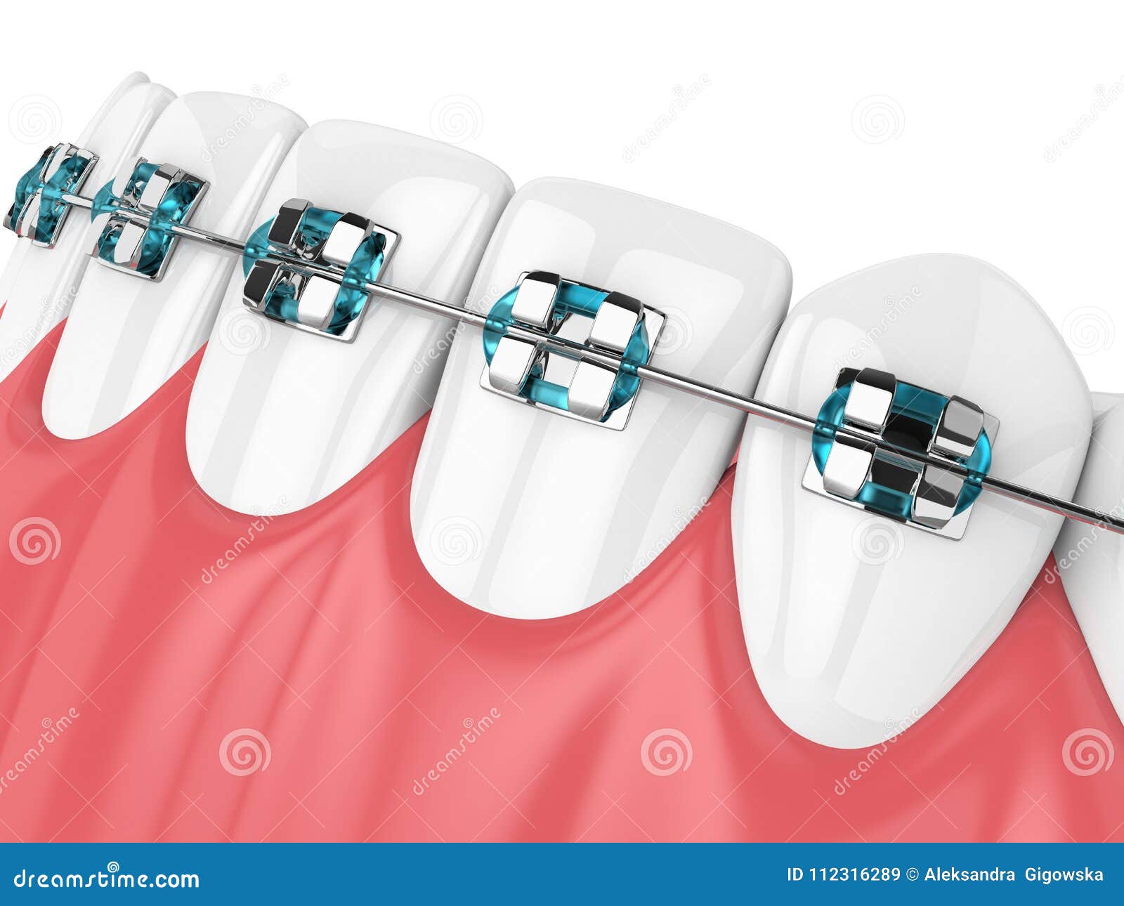 3d Render of Jaw with Teeth and Orthodontic Braces Stock Illustration