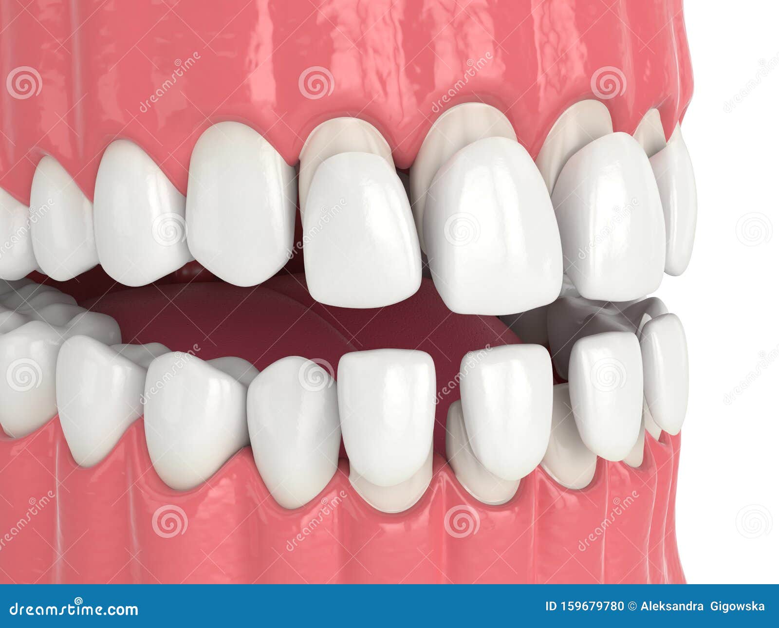 3d Render of Jaw with Upper and Lower Veneers Stock Illustration