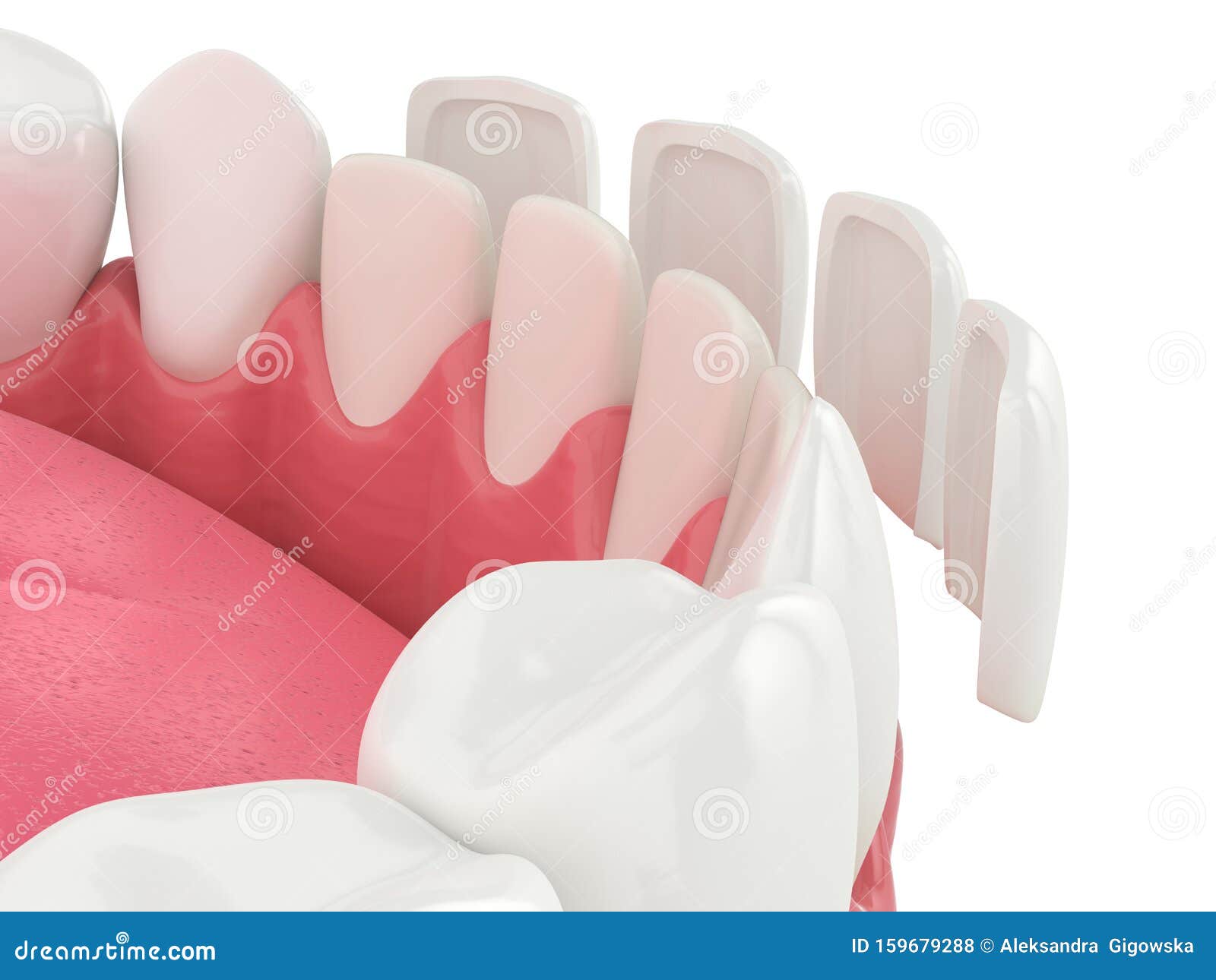 3d Render of Lower Jaw with Veneers Stock Illustration Illustration