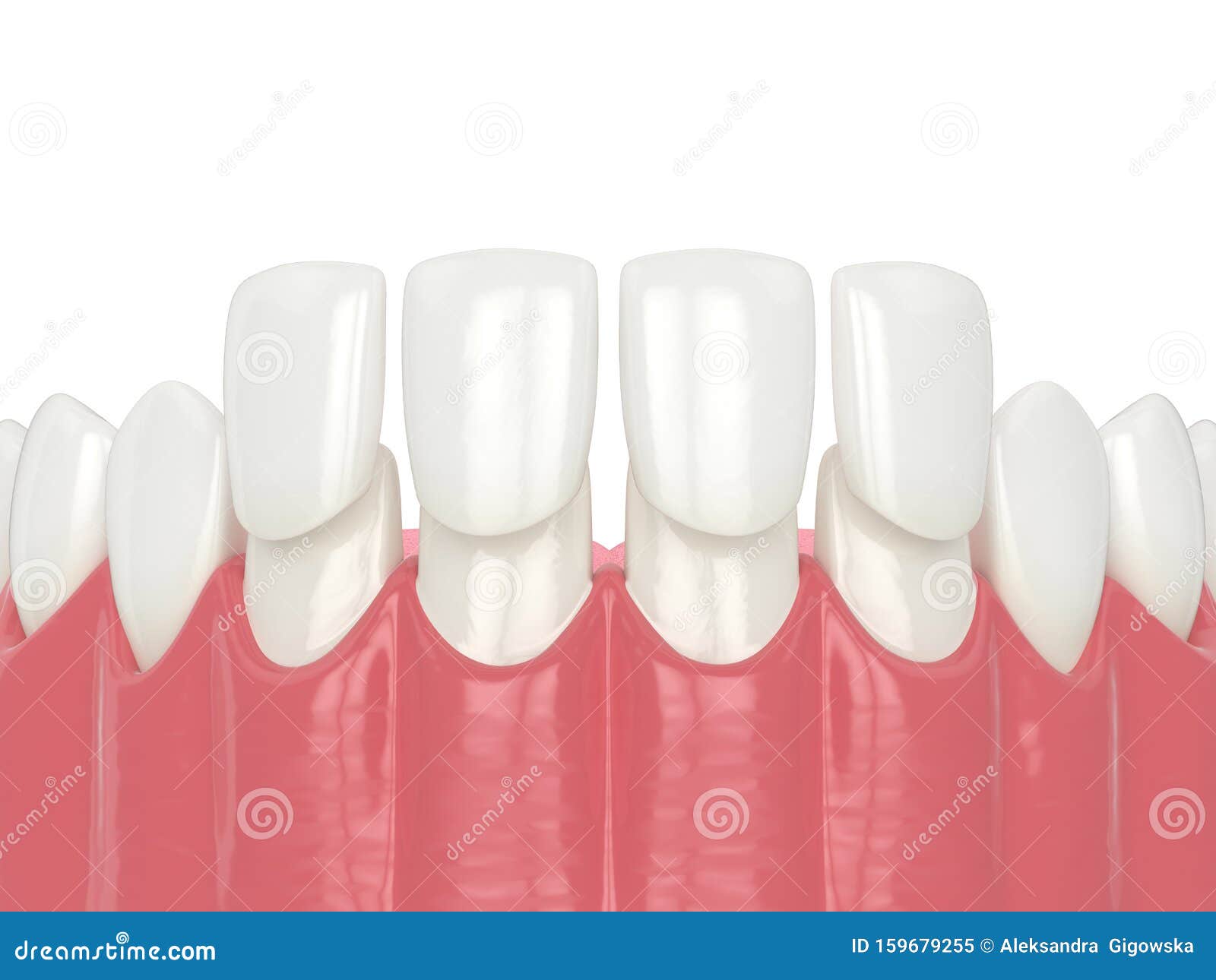 3d Render of Lower Jaw with Veneers Stock Illustration Illustration