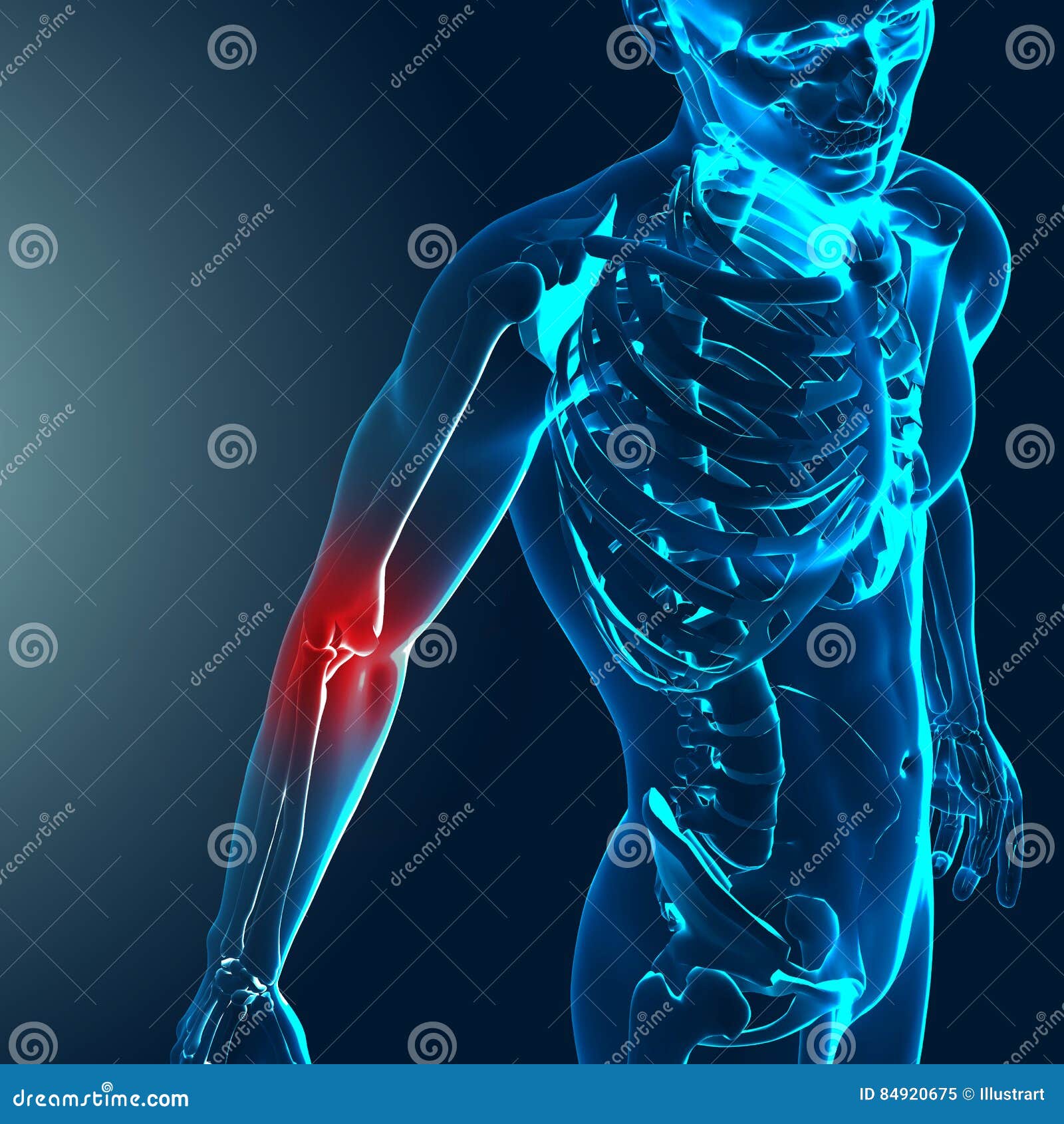 3d Render of a Medical Image with Painful Elbow Highlighted Stock