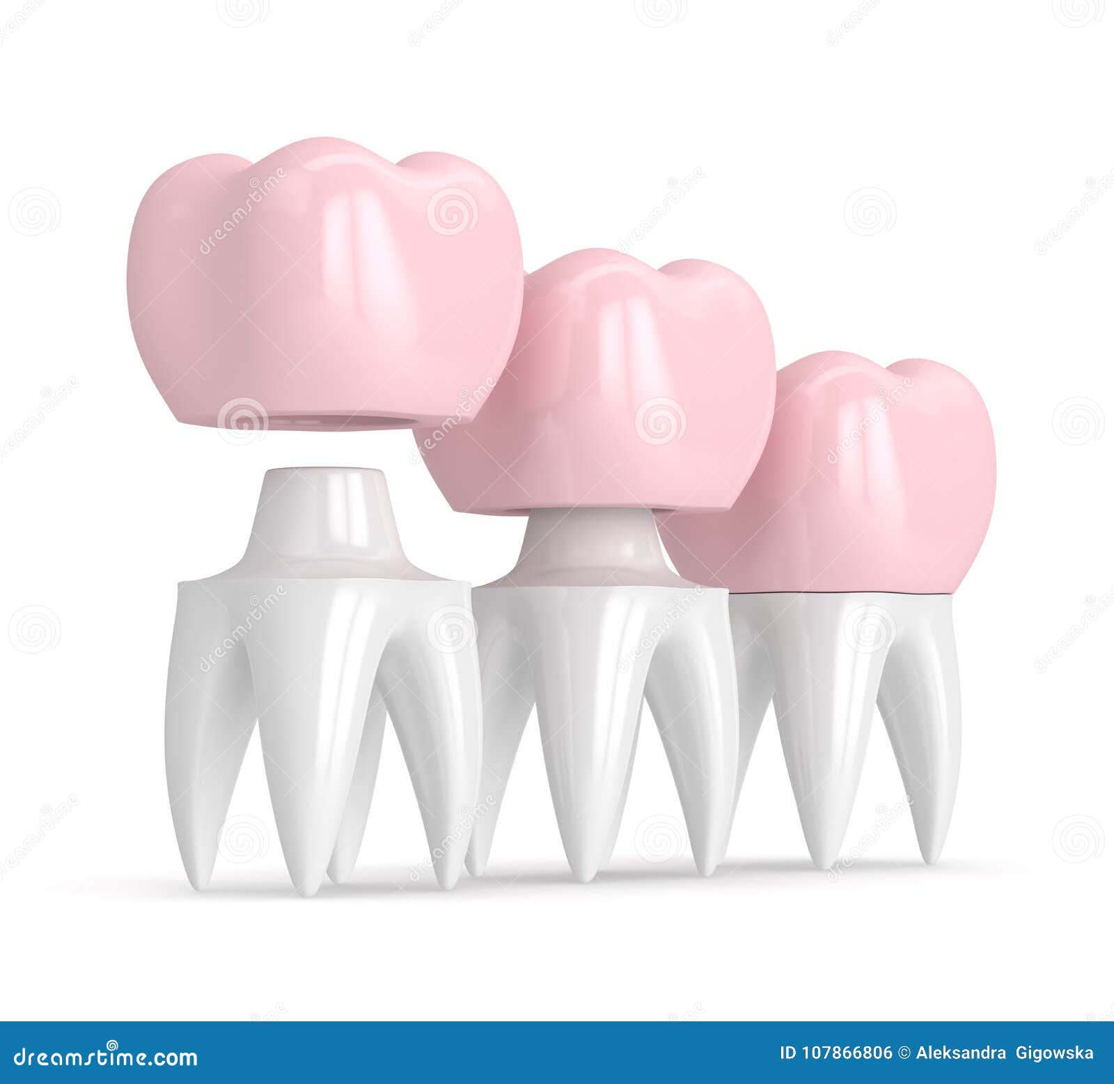 3d Render of Replacement Crown Cemented Onto Reshaped Tooth Stock