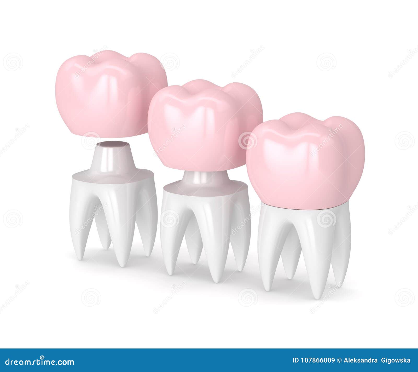 3d Render of Replacement Crown Cemented Onto Reshaped Tooth Stock