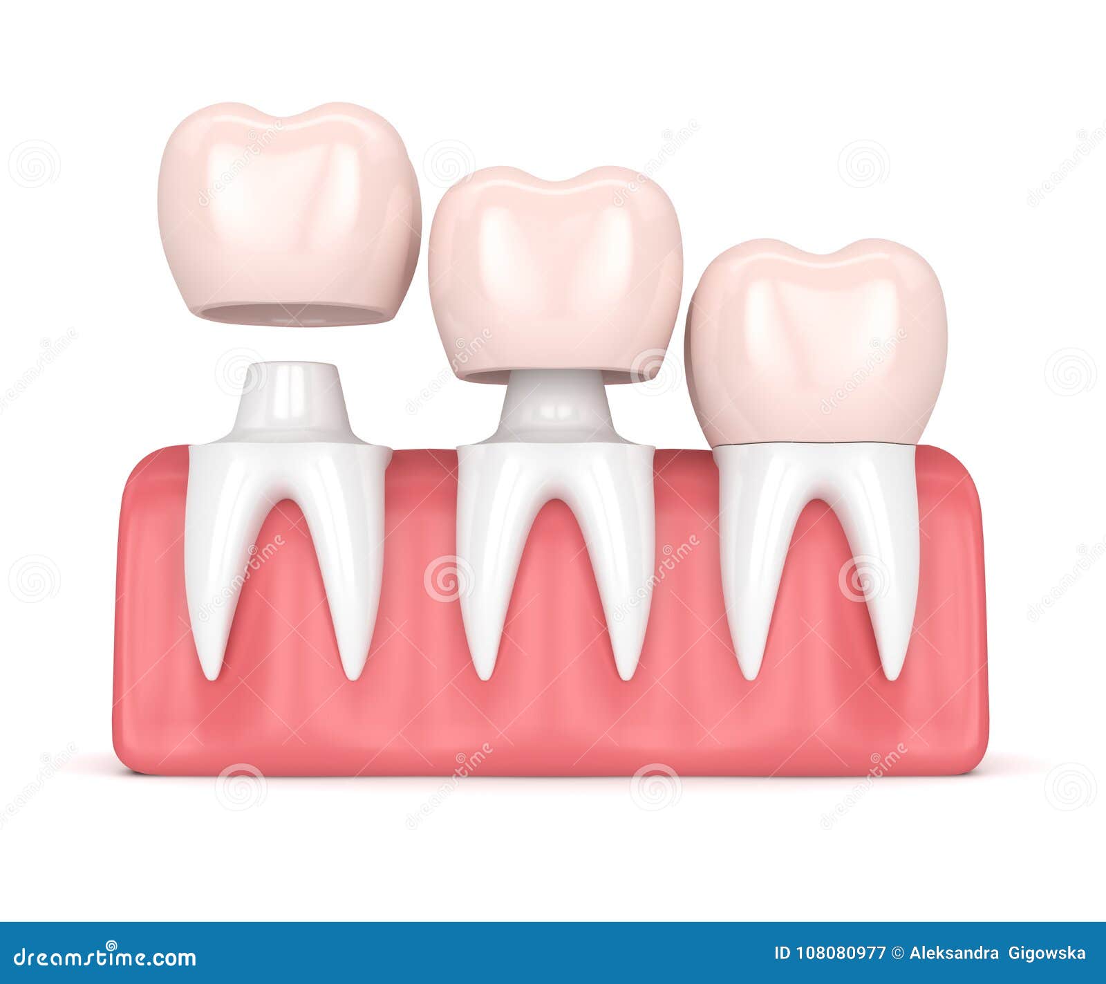 3d Render of Replacement Crowns Cemented Onto Reshaped Teeth Stock