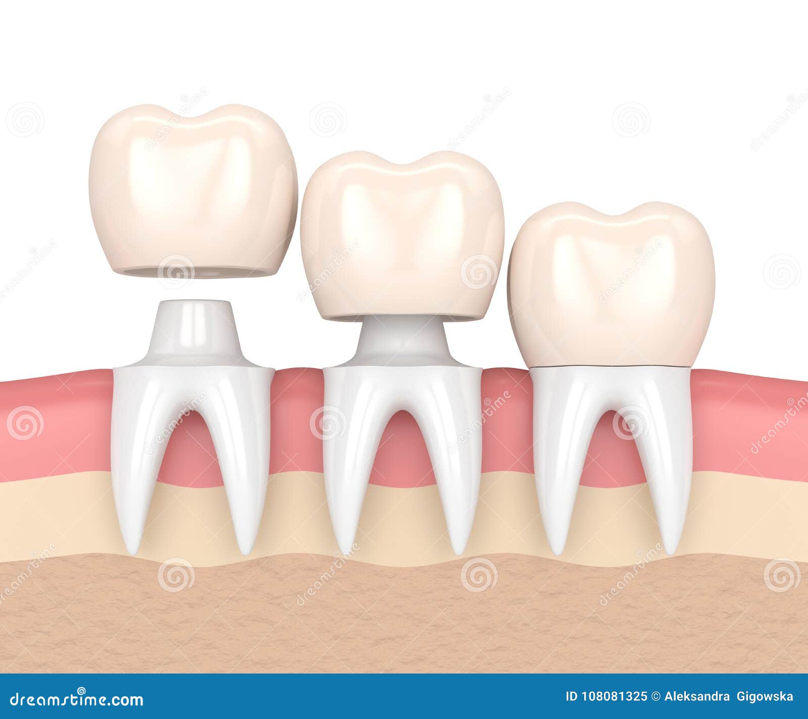 3d Render of Replacement Crowns Cemented Onto Reshaped Teeth Stock