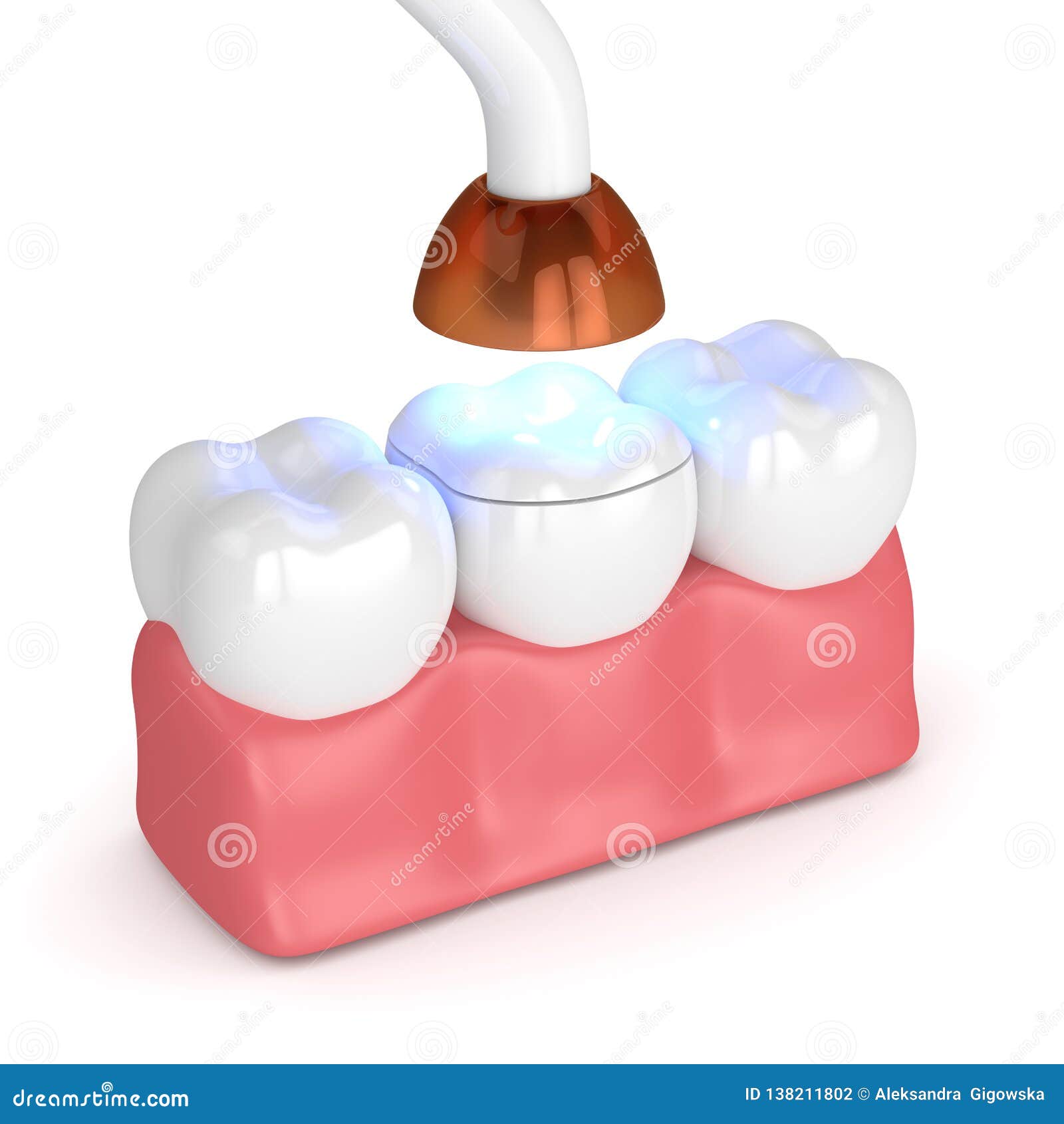 3d Render of Teeth with Dental Polymerization Lamp and Light Cured Onlay Stock Illustration