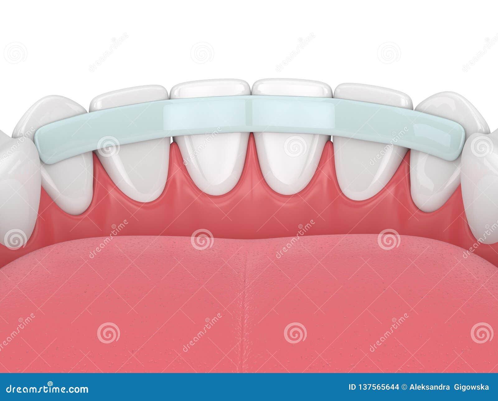 3d Render of Teeth with Dental Reinforcement Fiber Stock Illustration