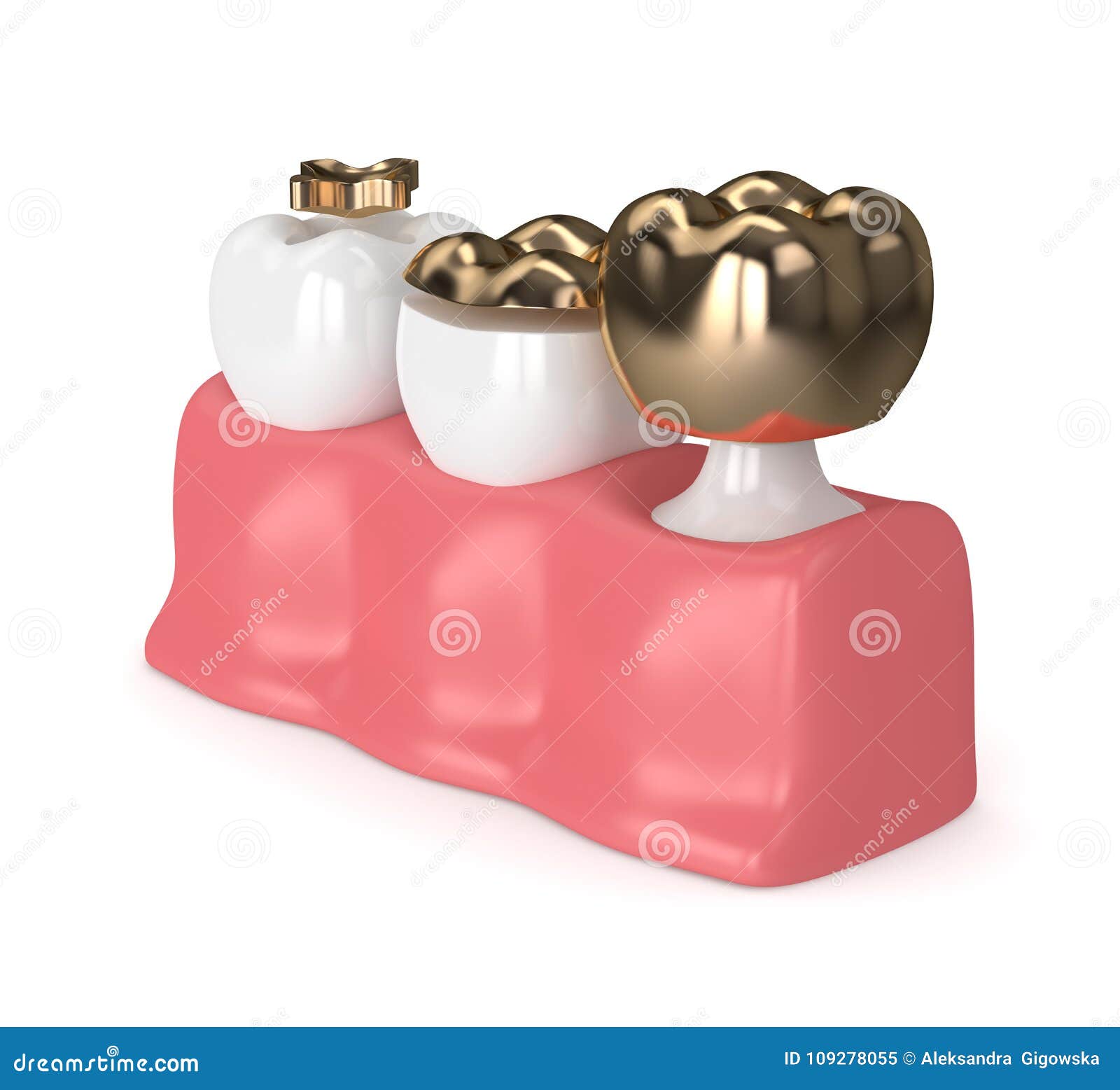 3d Render of Teeth with Different Types of Dental Gold Filling Stock