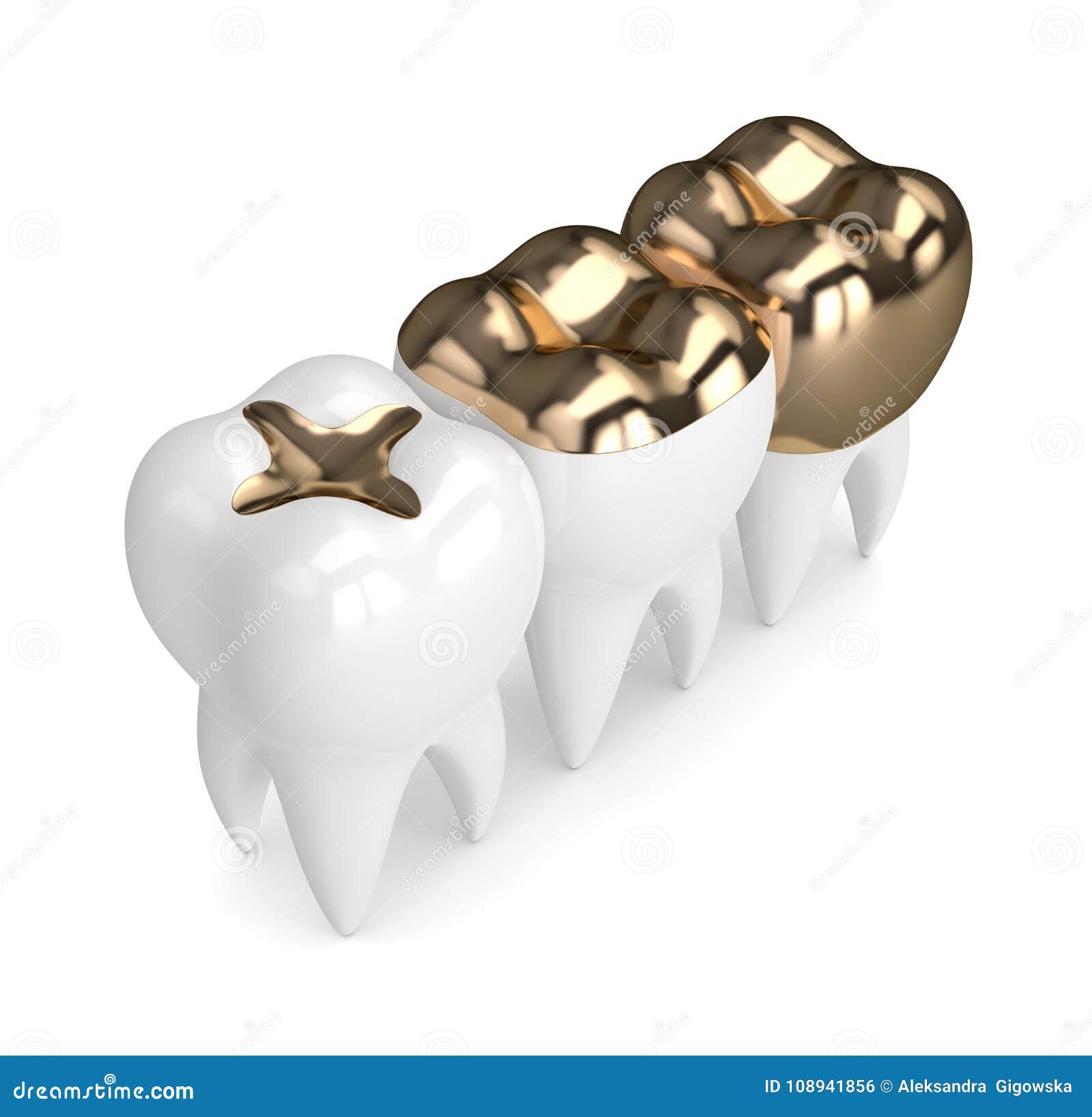 3d Render of Teeth with Different Types of Dental Gold Filling Stock