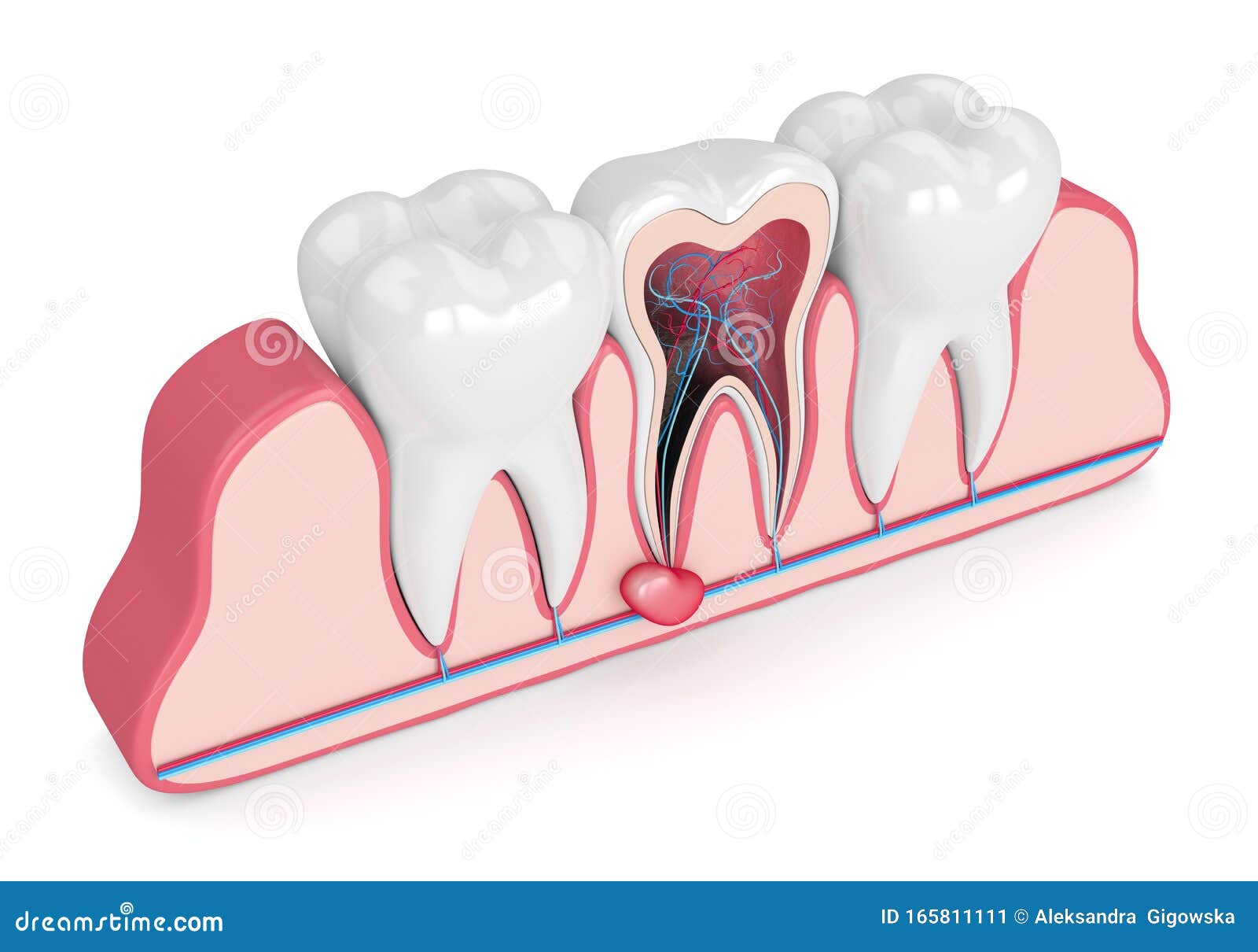 3d Render of Teeth in Gums with Cyst Stock Illustration Illustration