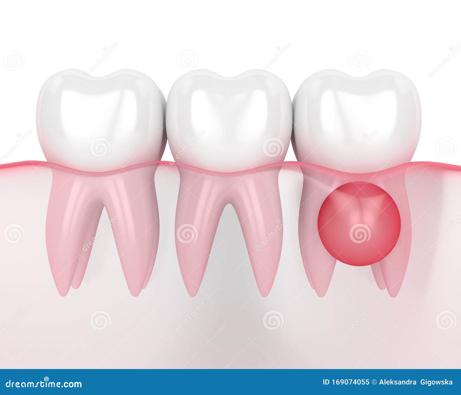 3d Render of Teeth in Gums with Cyst Stock Illustration Illustration