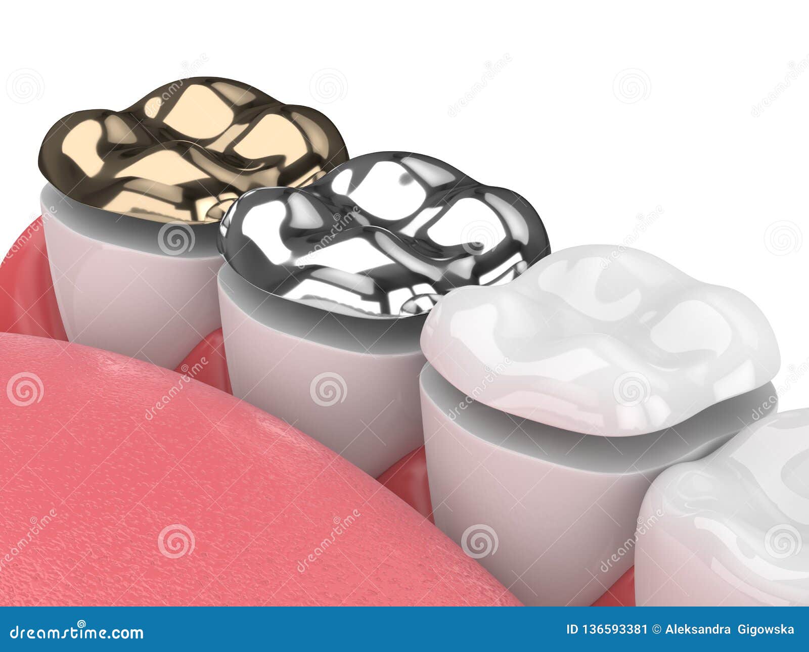 3d Render of Teeth with Onlay Stock Illustration Illustration of