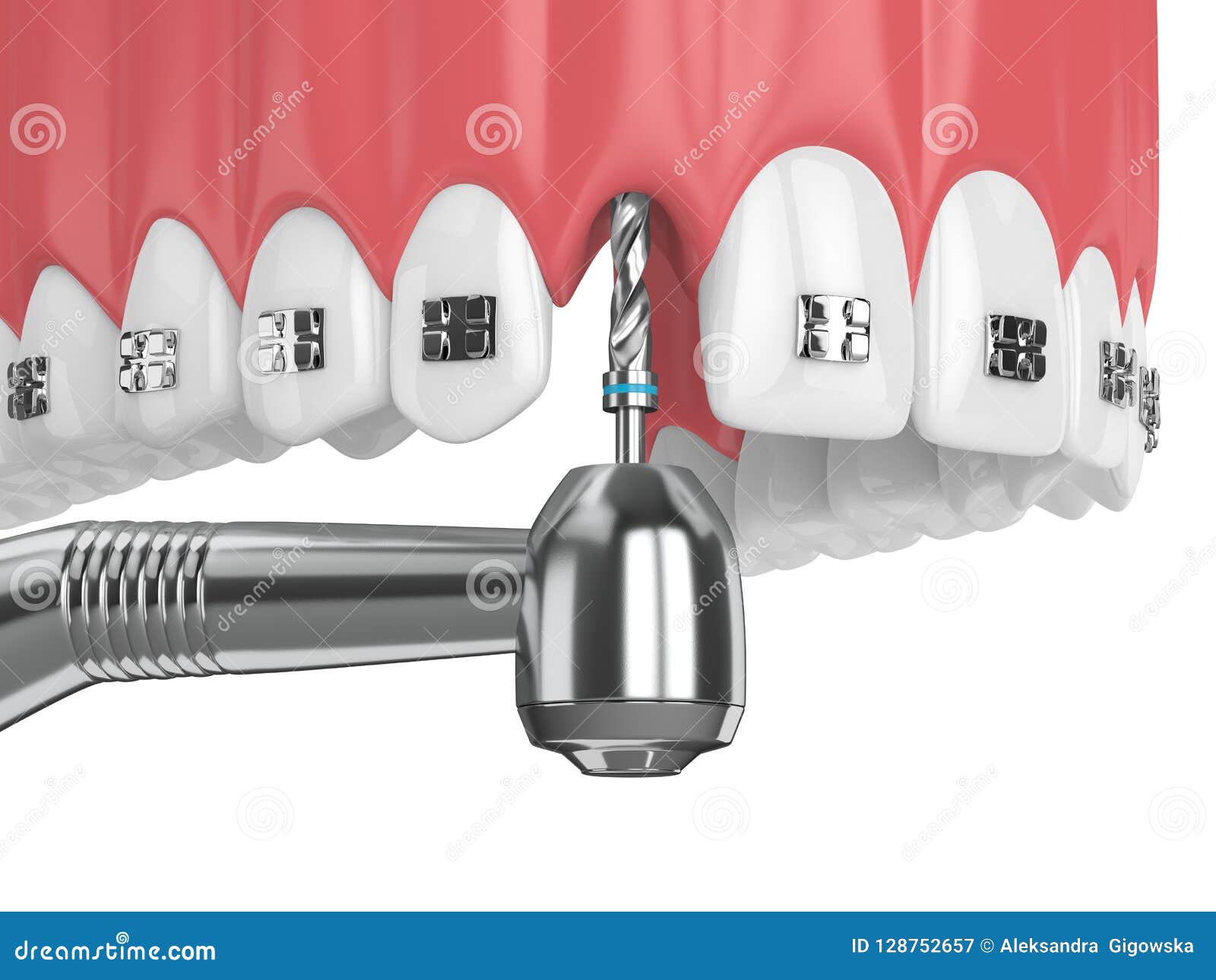 3d Render of Teeth with Orthodontic Braces and Dental Drill Stock