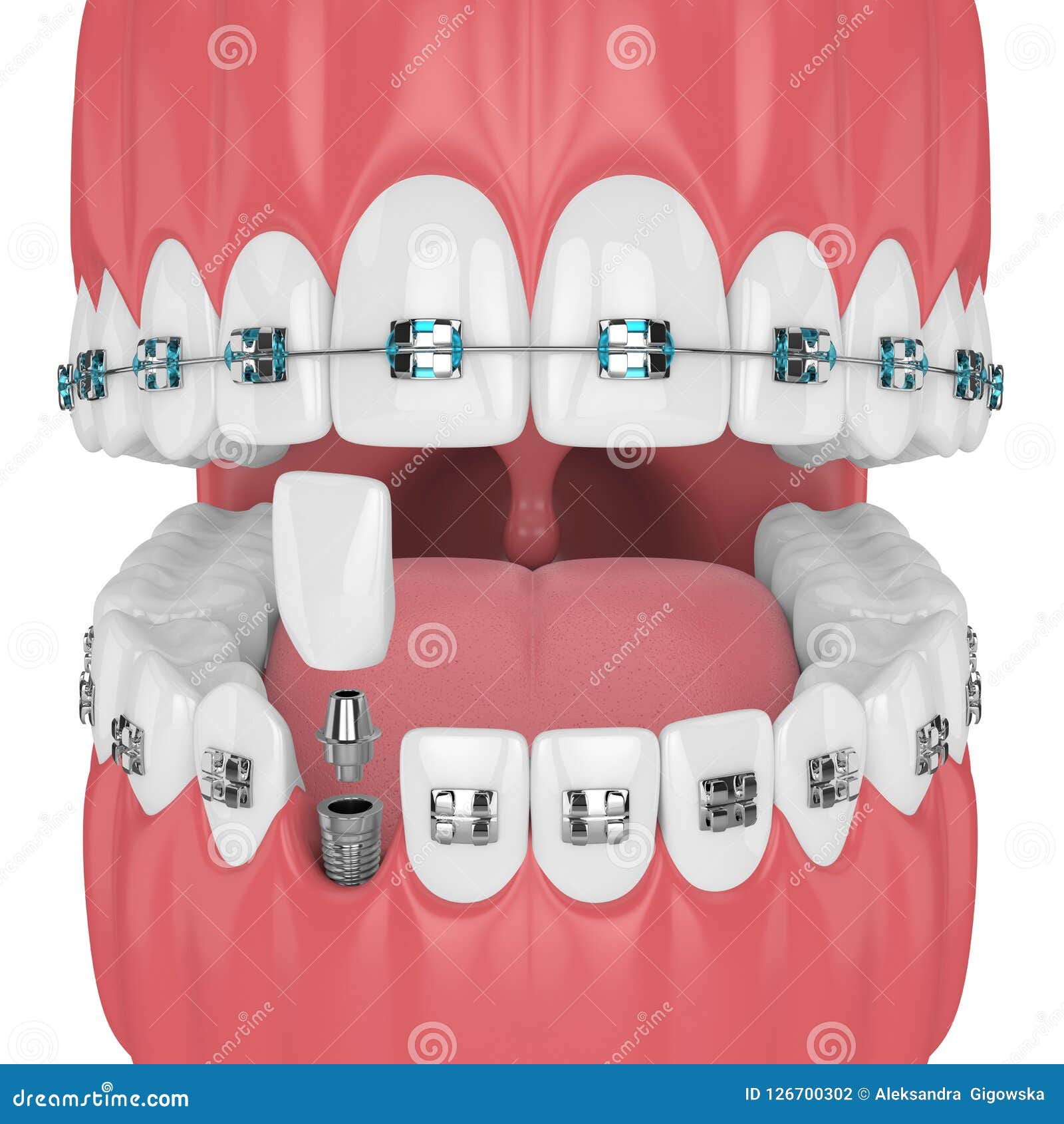 3d Render of Teeth with Orthodontic Braces and Dental Implant Stock