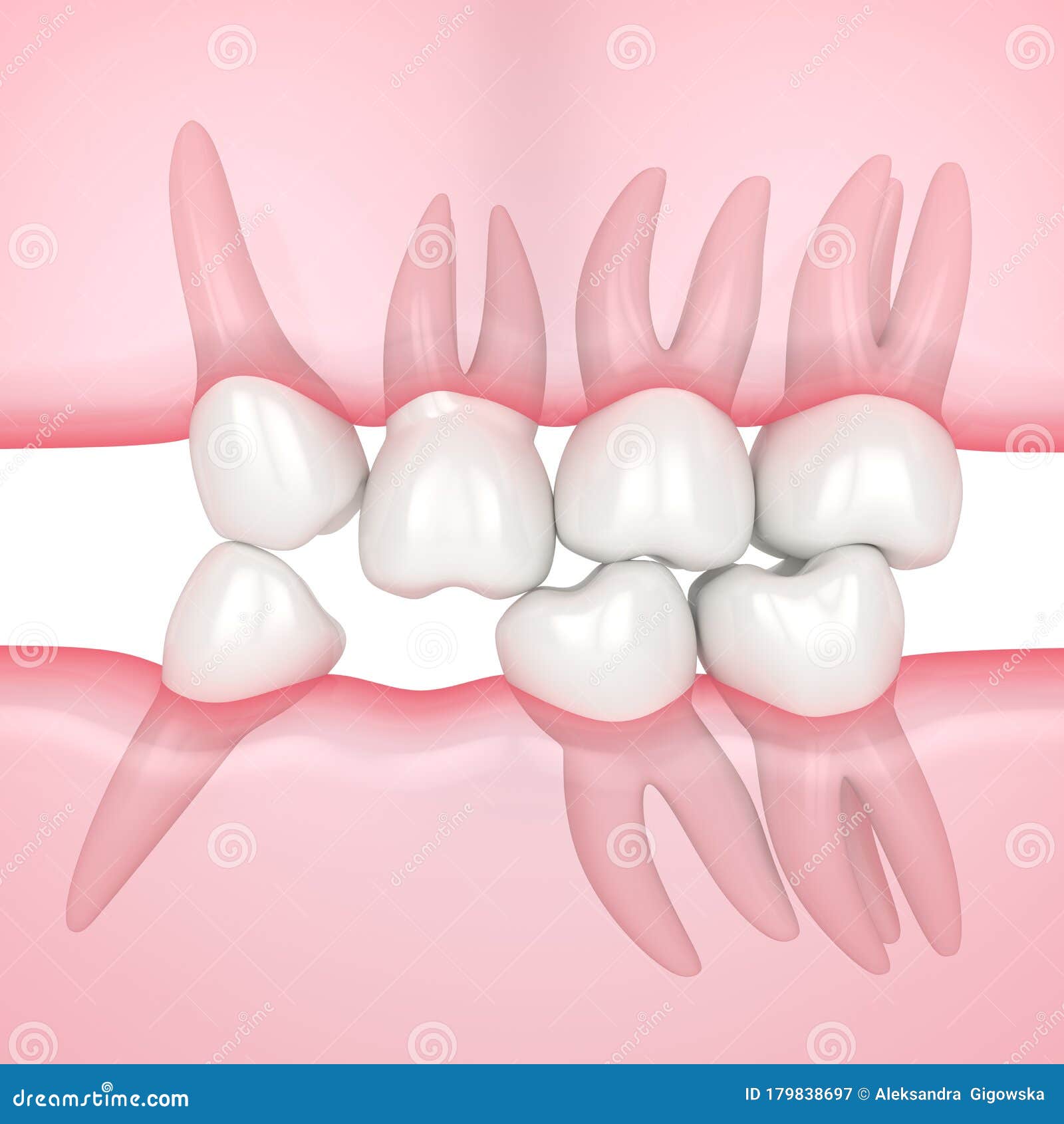 render of teeth 3d Render of Teeth Sliding Towards the Area of Missing Tooth in Order To  Fill the Gap Stock Illustration - Illustration of anchorage, protruding:  179838697