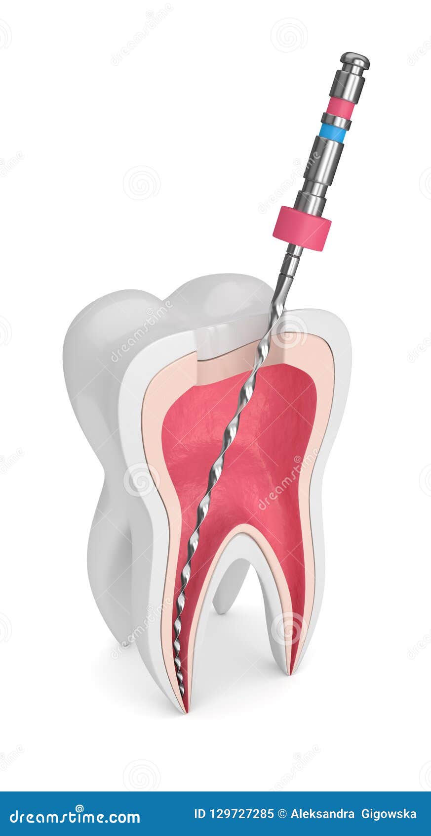 3d render of tooth with endodontic file