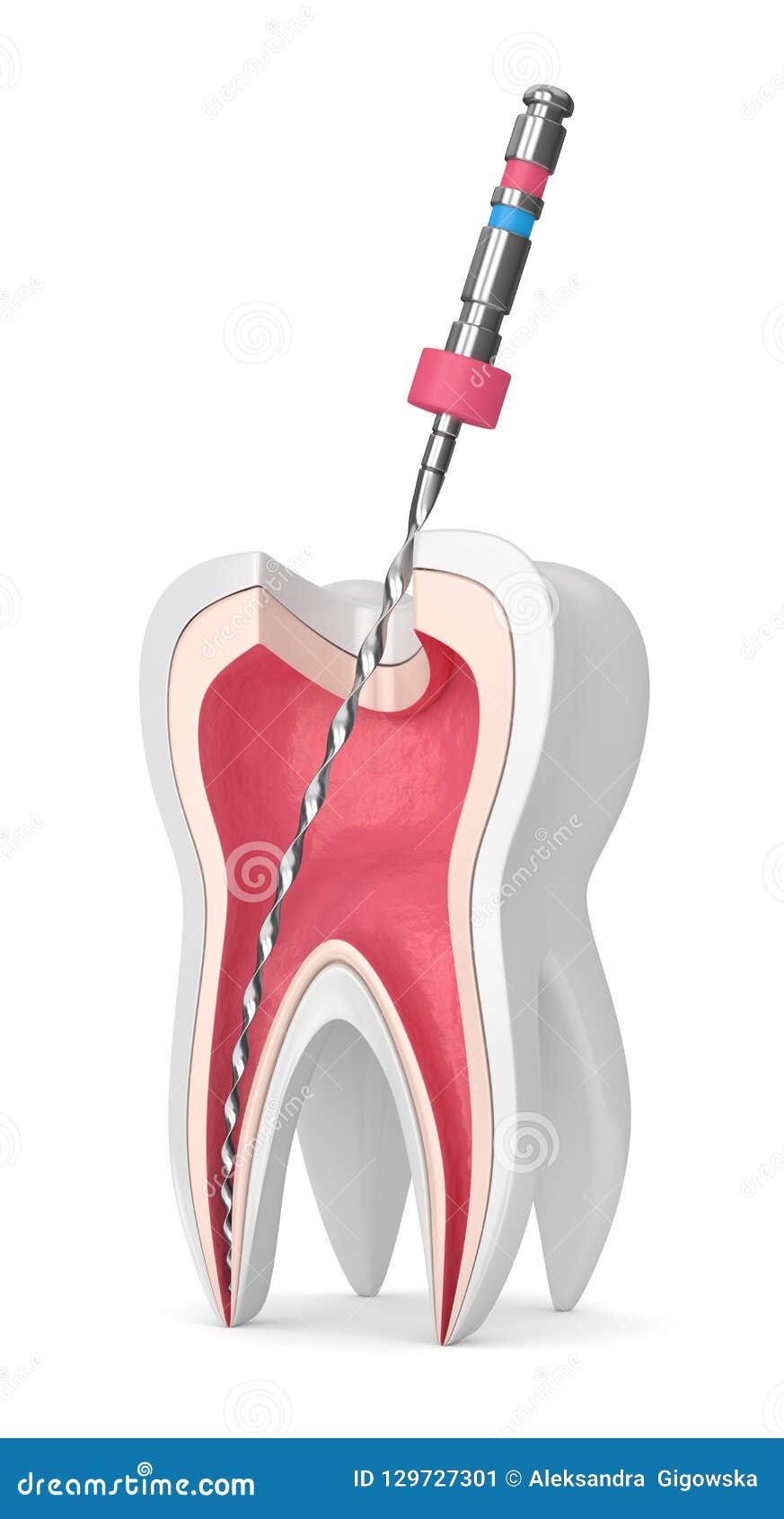 3d render of tooth with endodontic file