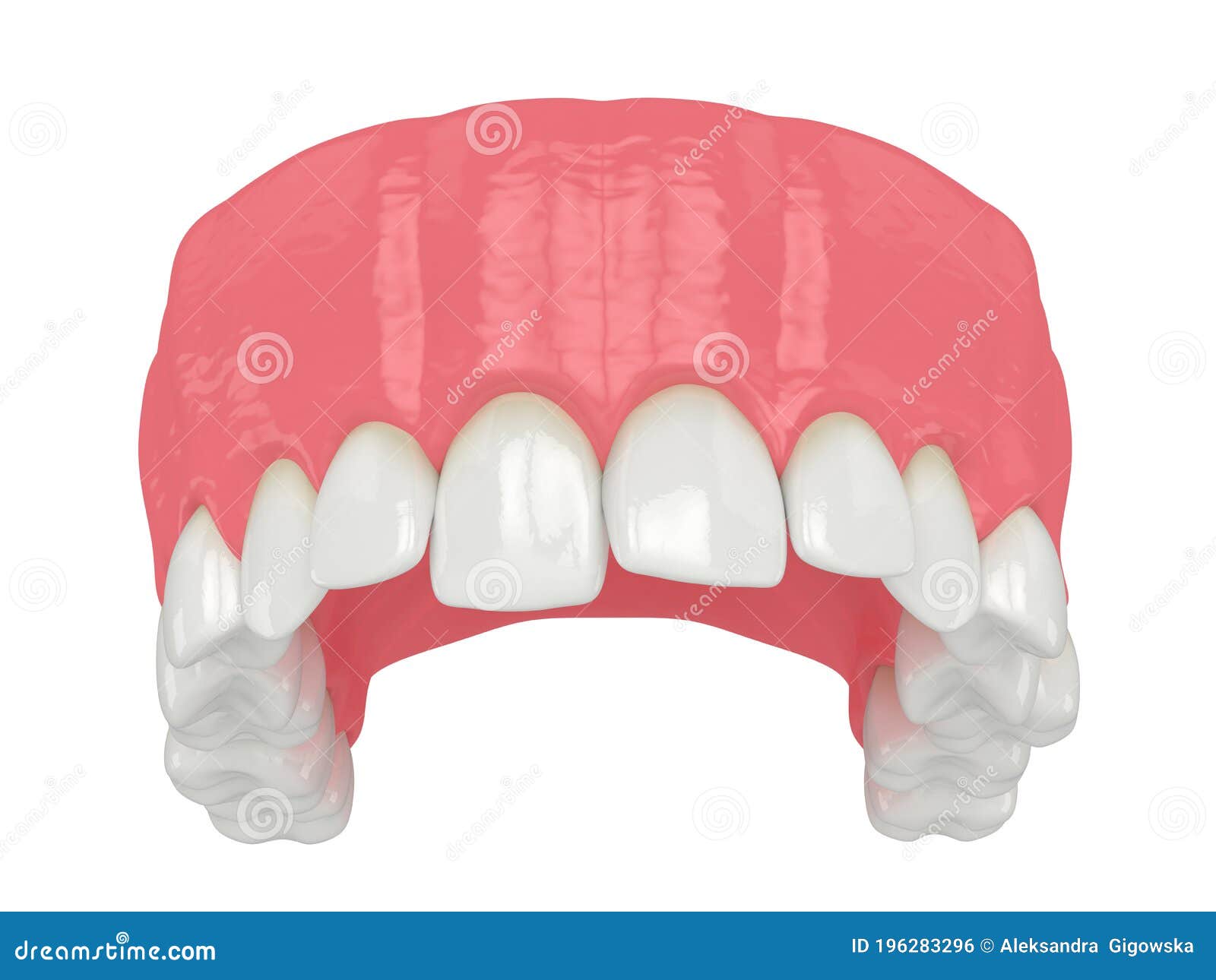 3d Render of Upper Jaw with Abnormal Teeth Position Stock Illustration
