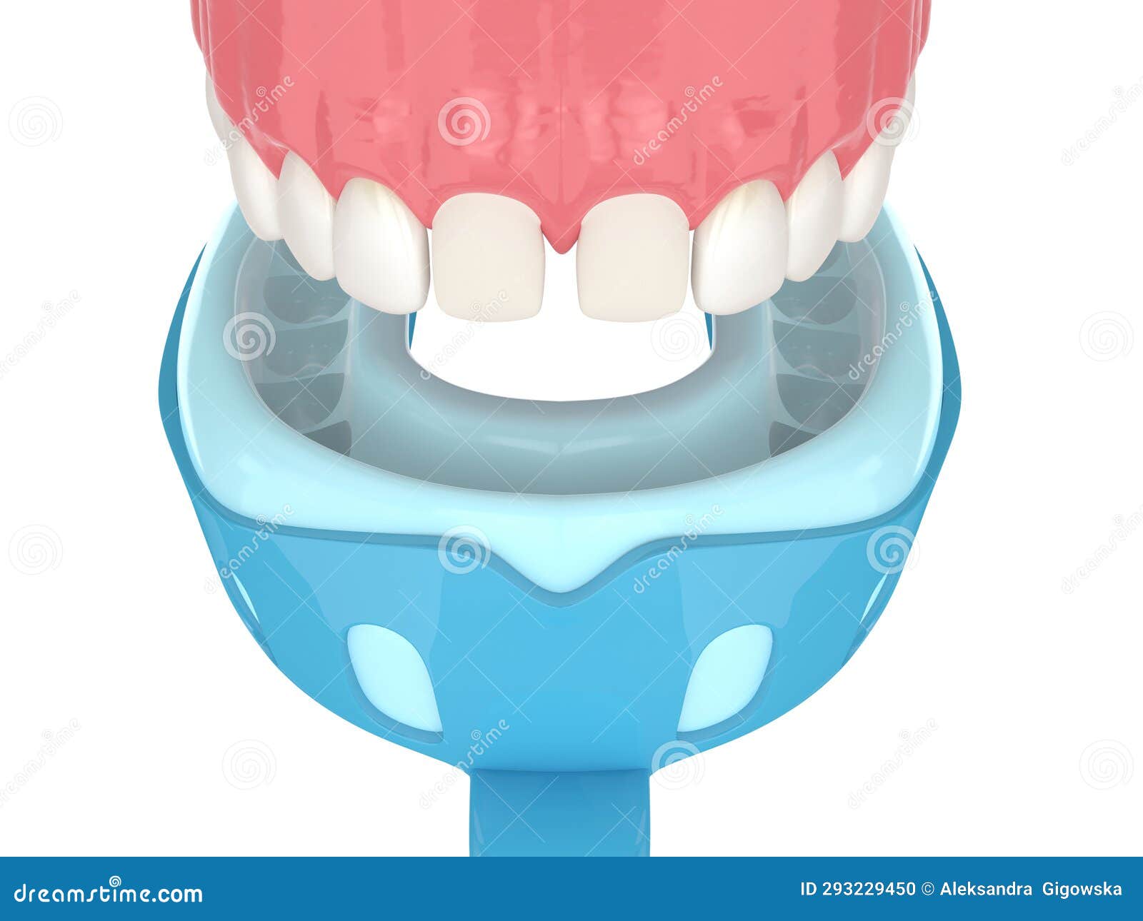 3d Render of Upper Jaw with Dental Impression Tray Stock Illustration