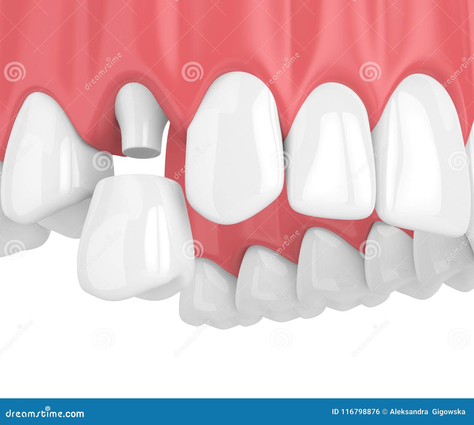 3d render of upper jaw with teeth and dental premolar crown