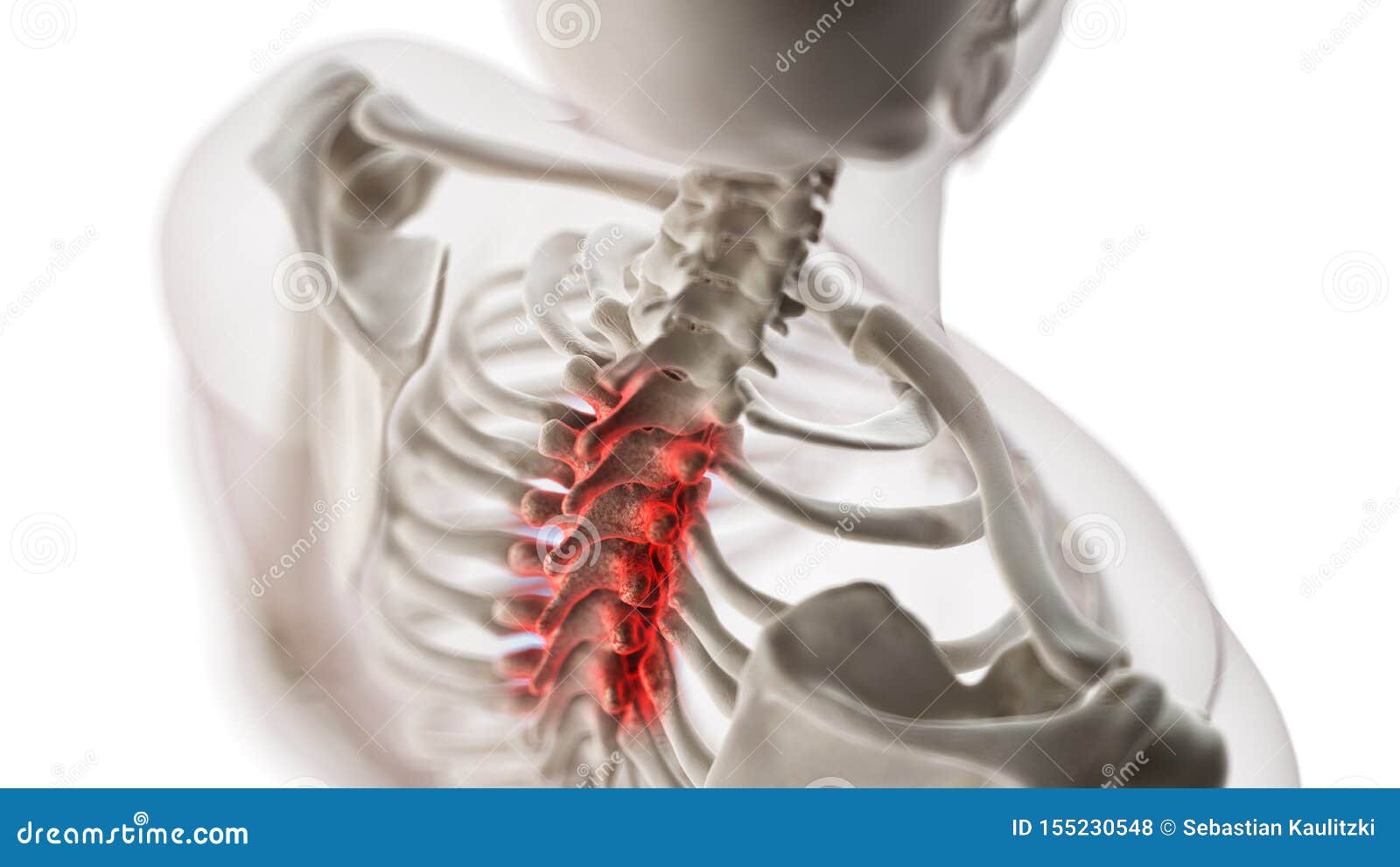 an arthritic thoracic spine
