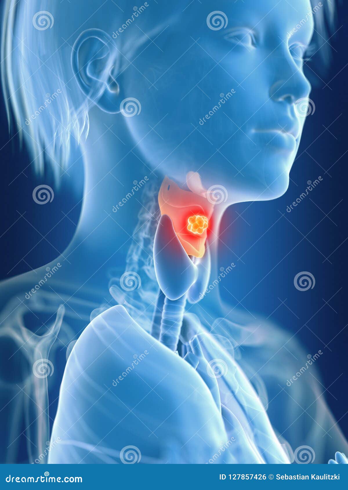 a females larynx cancer
