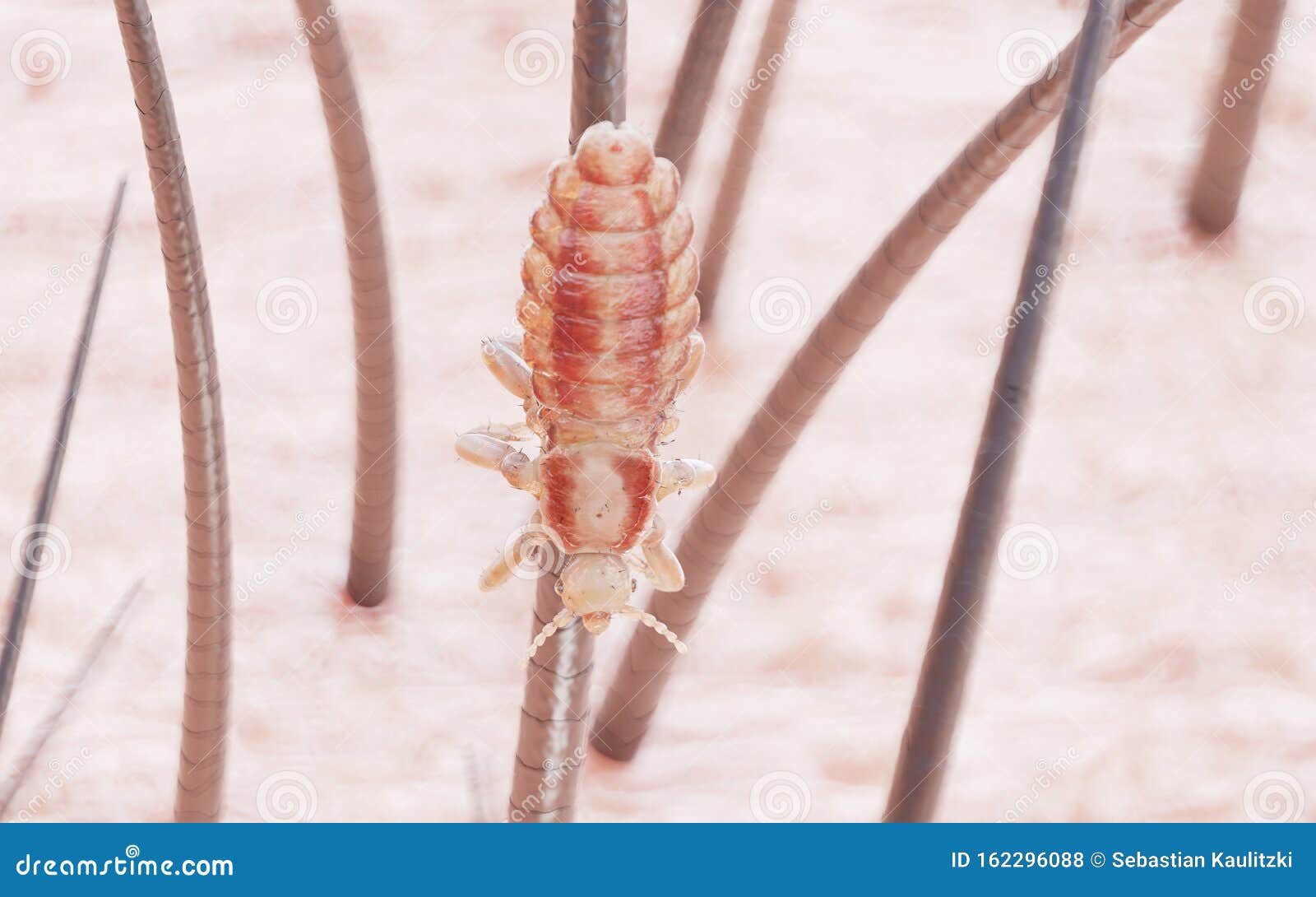 A head louse stock illustration. Illustration of disease 162296088