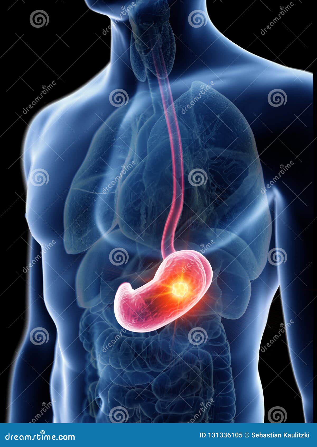 A mans stomach tumor stock illustration. Illustration of organs - 131336105