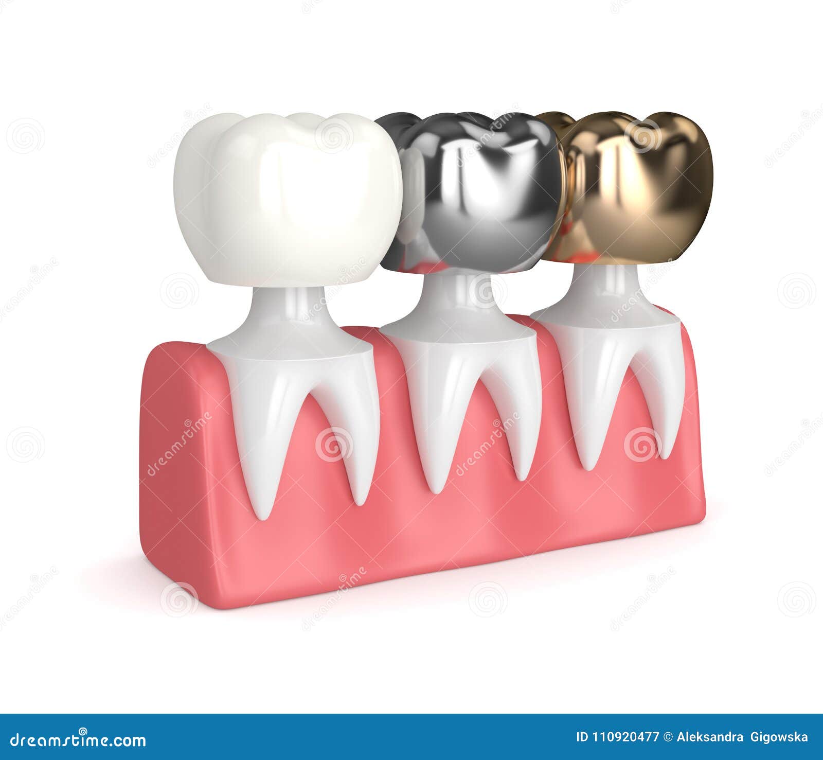 Set Cunei Di Fissaggio Elastico Dentale Matrici Sagomate Sezioni Diga - Foto 7