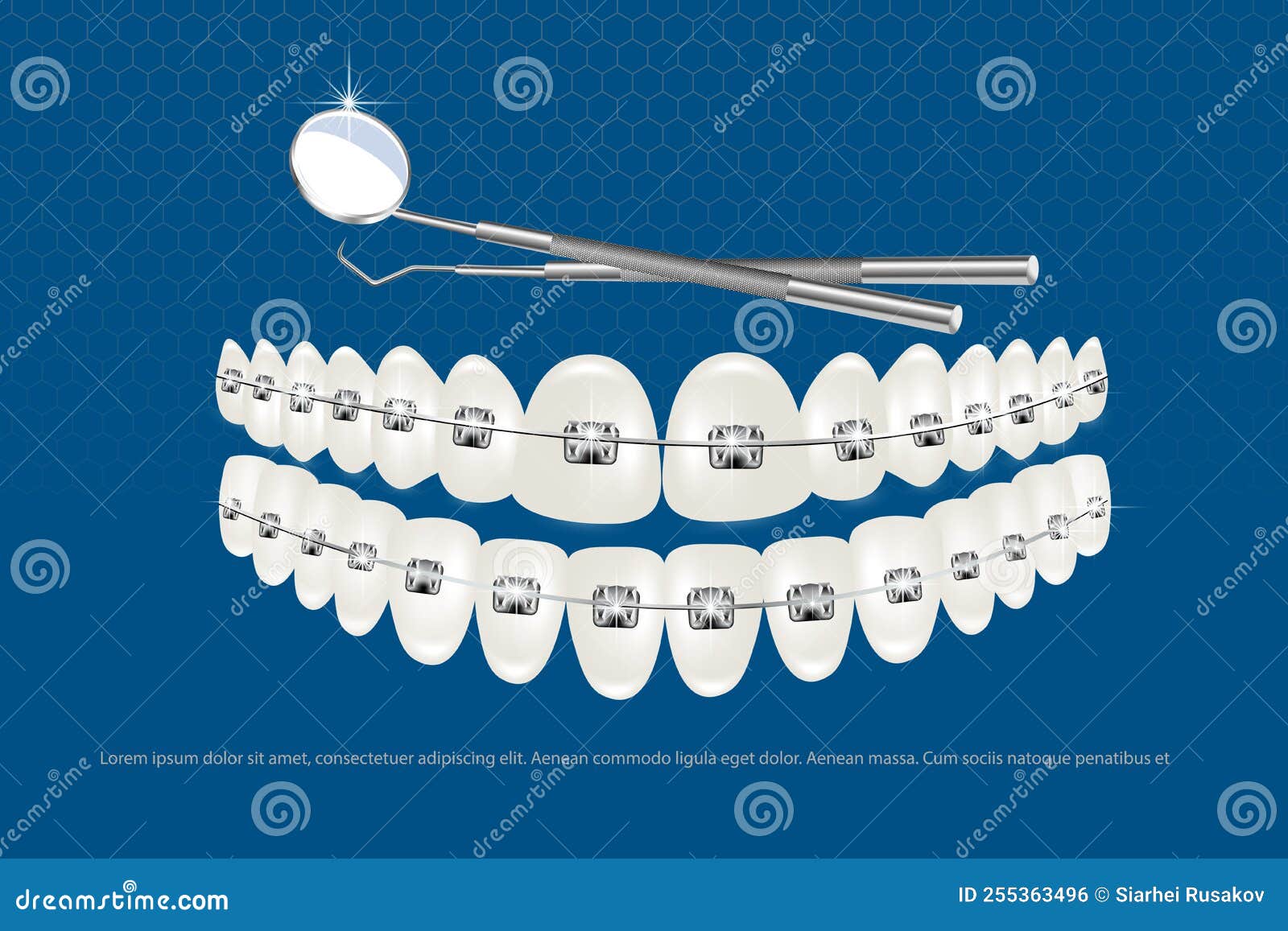 3d Vector Illustration, Realistic Teeth with Braces Upper and Lower Jaw