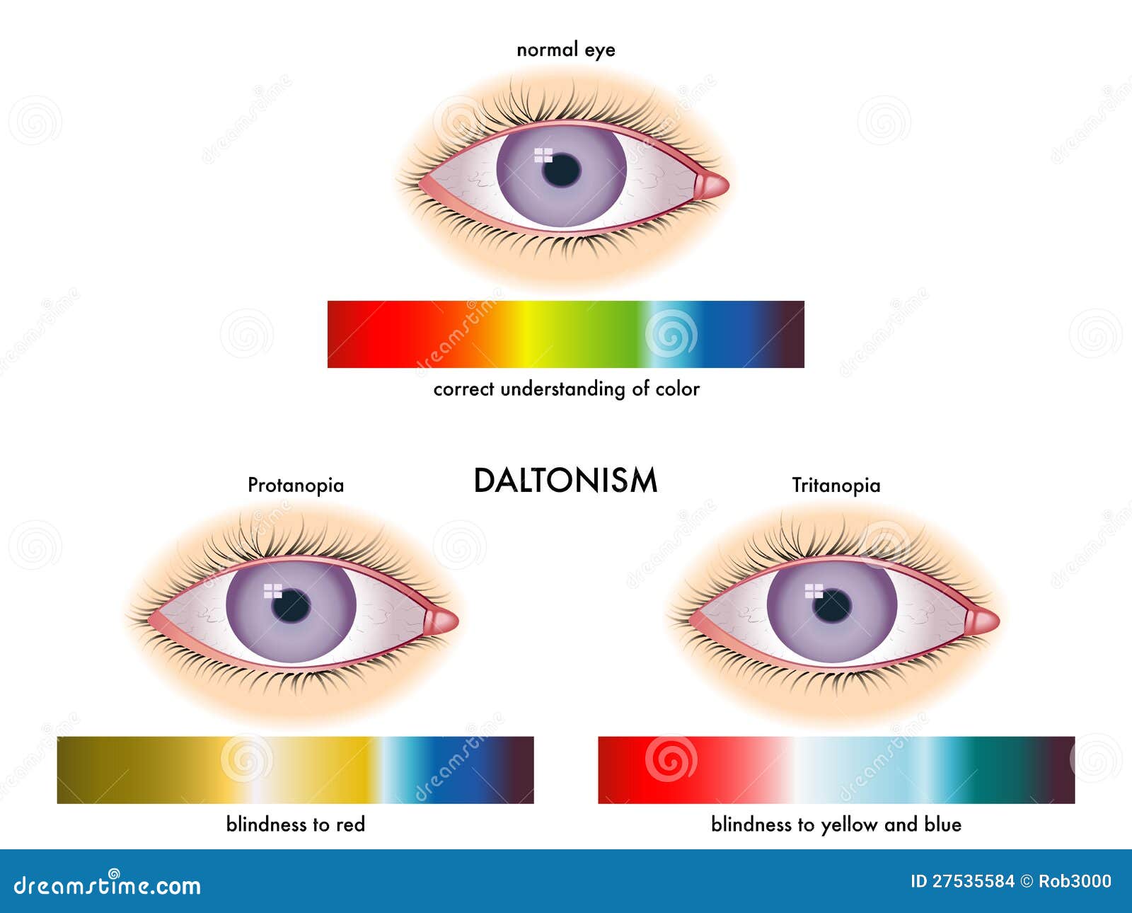 DALTONISMO
Es una afección en la cual no se pueden ver los colores de manera normal. También se conoce como deficiencia de co