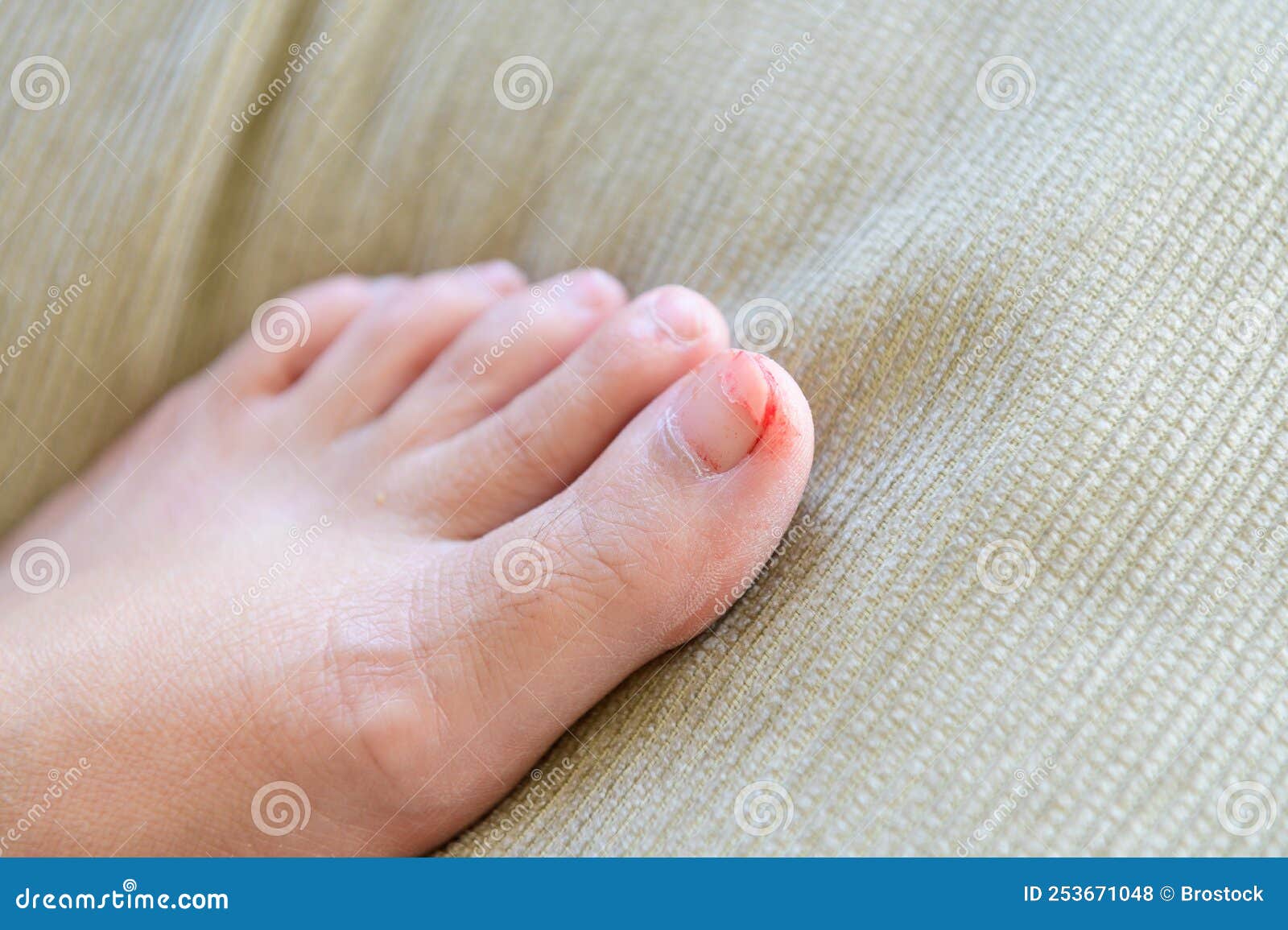 Damage To the Nail Plate on the Leg Stock Photo Image of medicine
