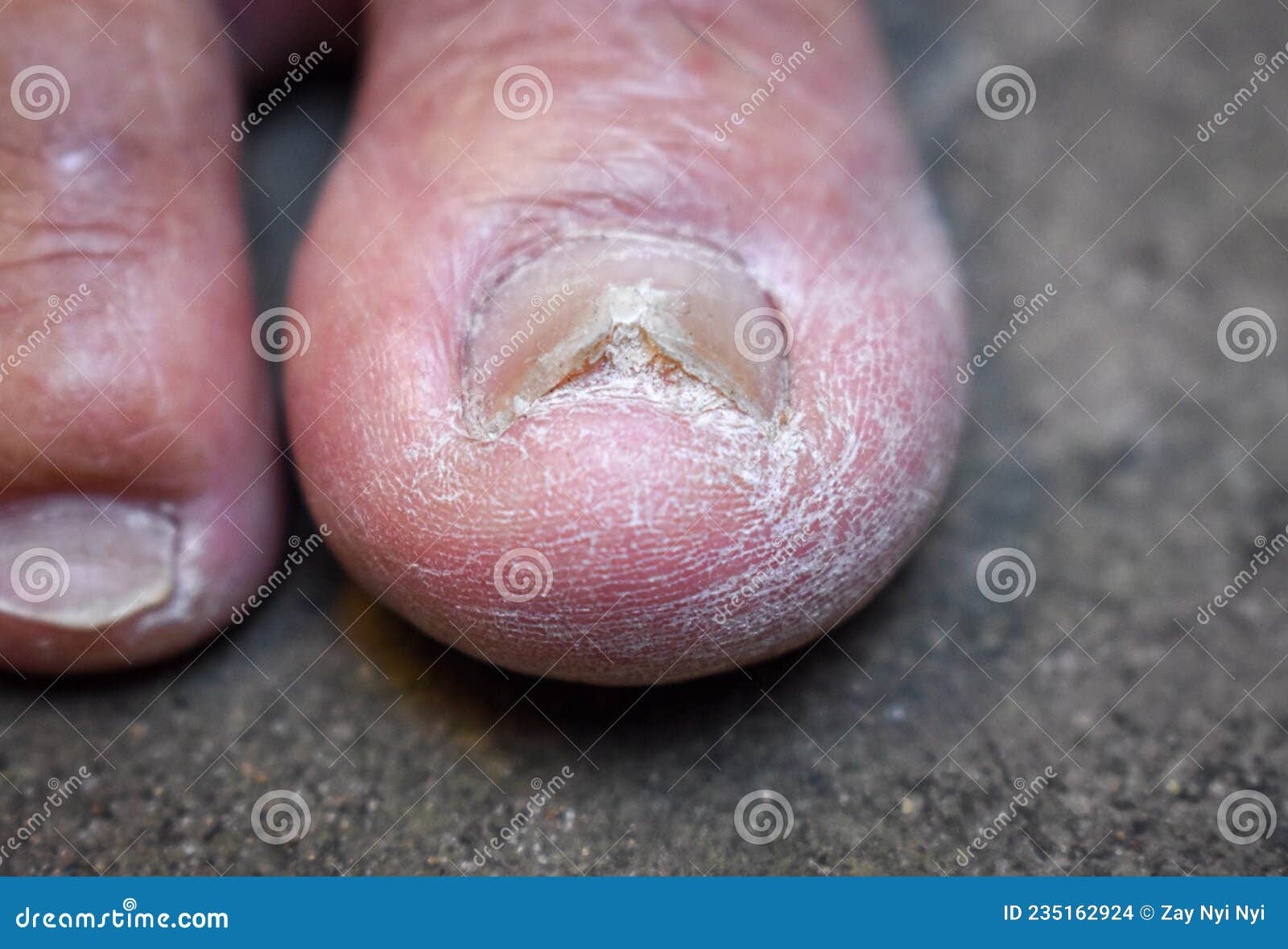 Fungal Nail Infection. Onychomycosis, Also Called Tinea Unguium Stock Photo  - Image of ridge, elder: 235162924
