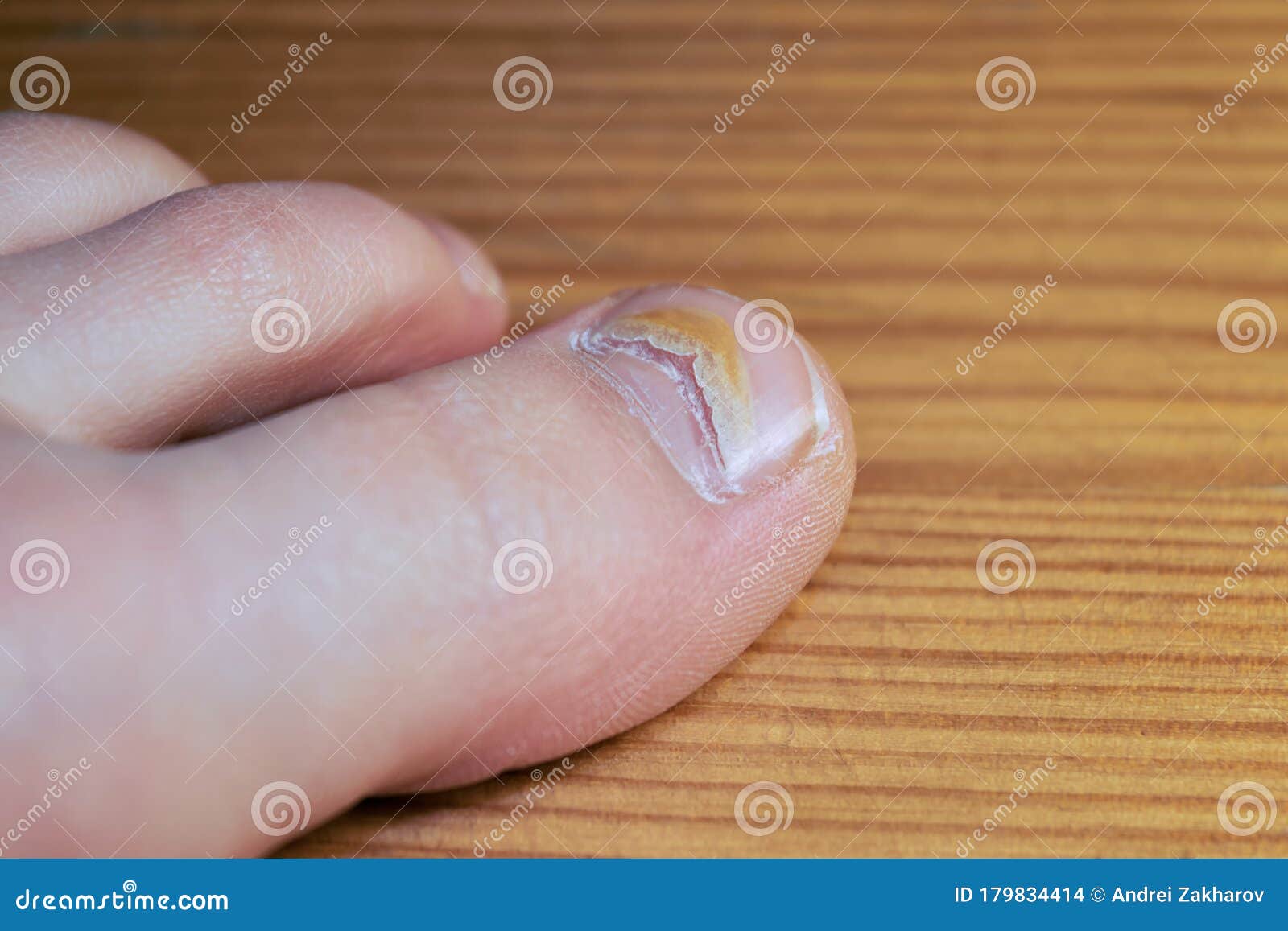 Damaged the Nail on My Big Toe from the Virus Stock Photo - Image of diagnosis, enterovirus: 179834414 Damaged the Nail on My Big Toe from the Virus Stock Photo - Image of diagnosis, enterovirus: 179834414