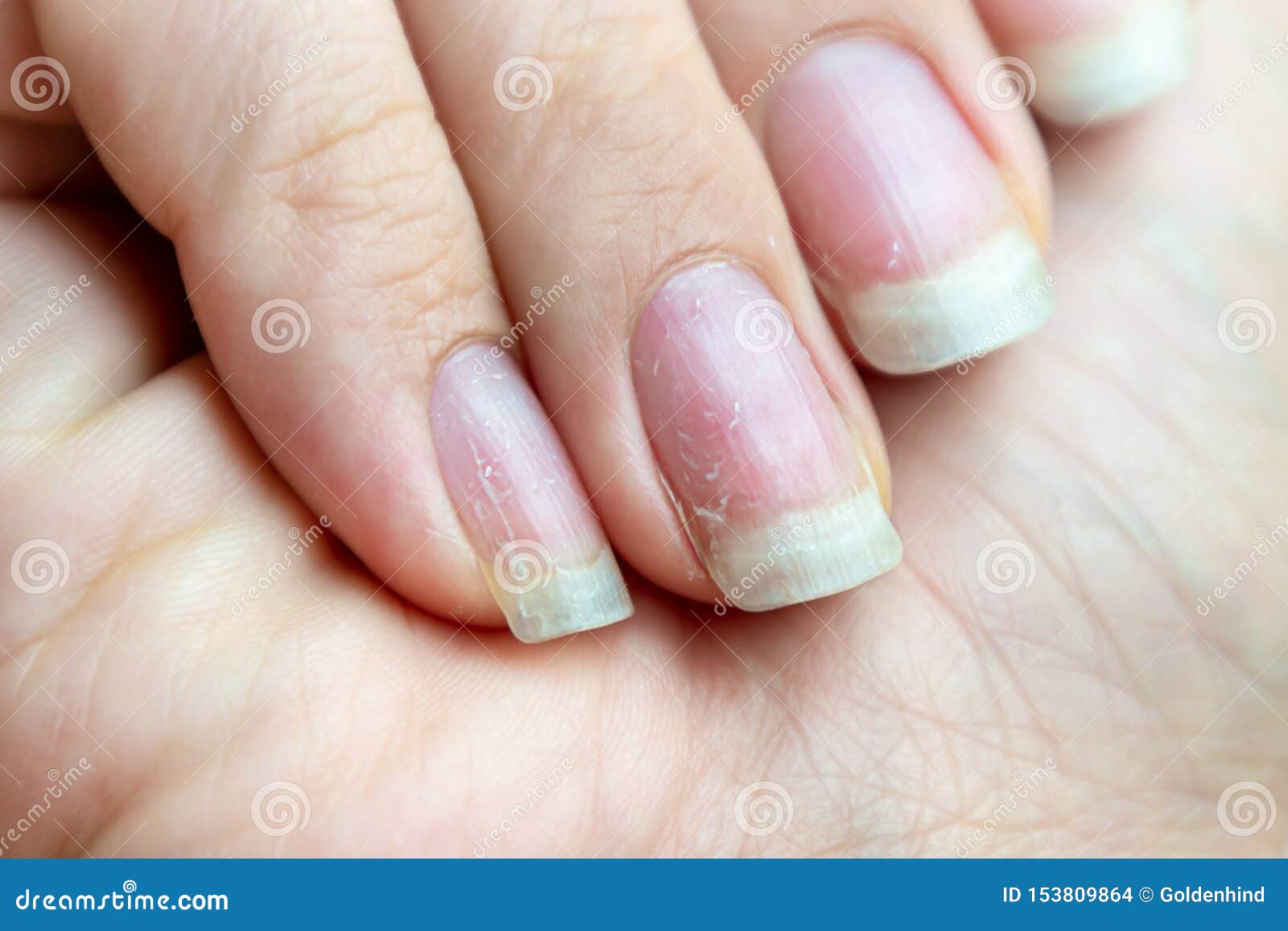 Damaged Nails that Have Problem after Doing Manicure. Health and Beauty  Problem Stock Photo - Image of disease, finger: 153809864