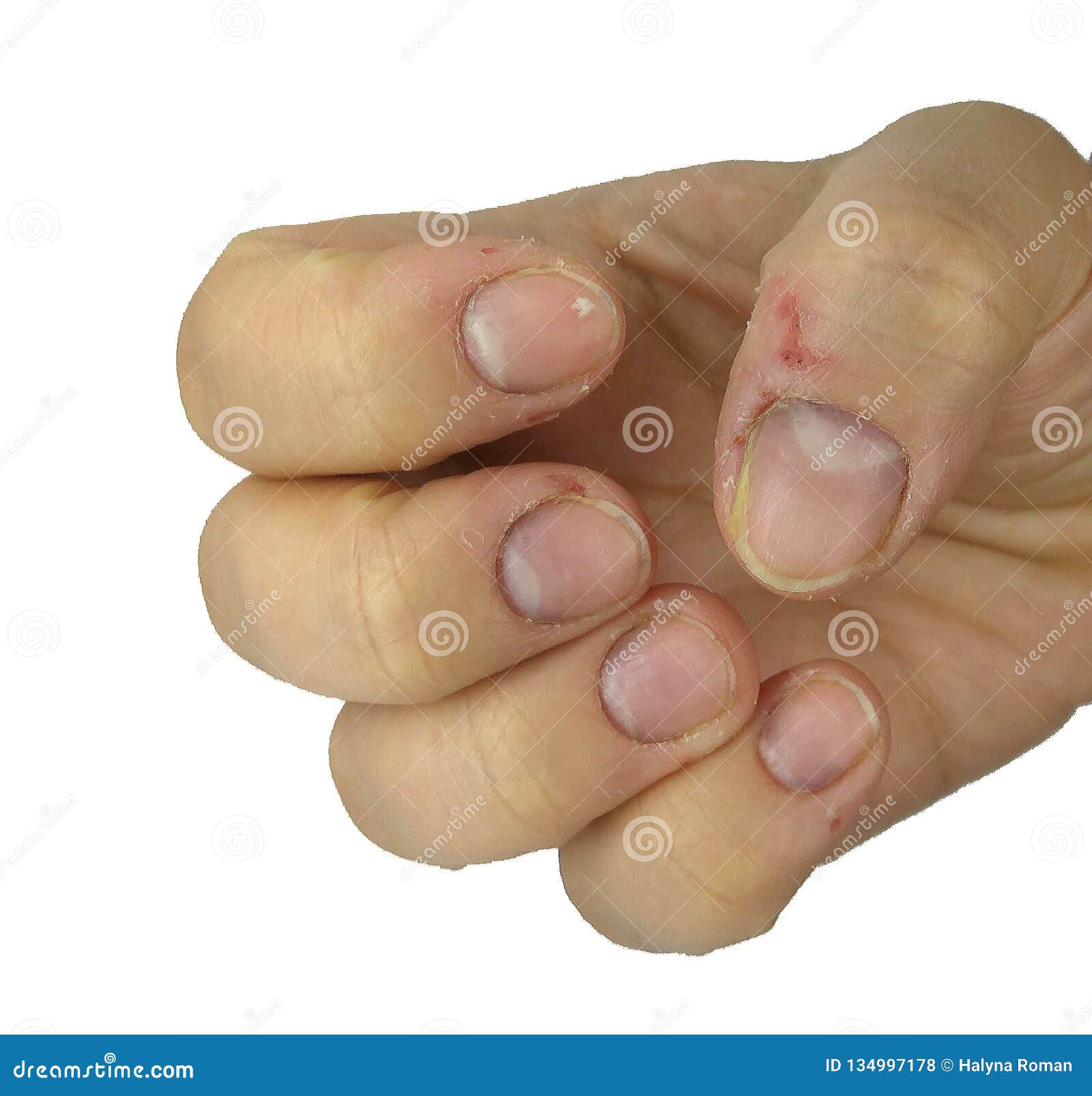 Fingers with signs of nail biting Close up of adult female hand with  chewed nails and