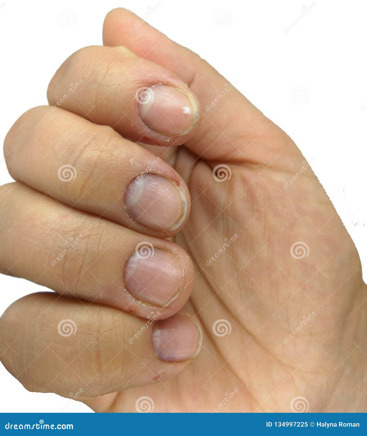 My nails are horrible due to years of biting them. The cuticles are a mess  as well as the skin around the nails. Is there anything I can do to help  them