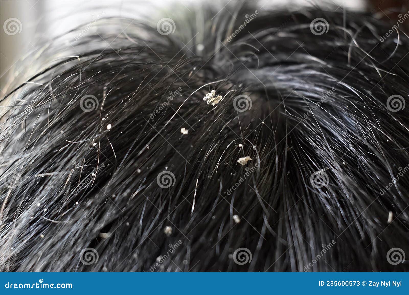 Dandruff Flakes and Premature Hair Whitening. Early Aging Stock Image -  Image of early, flakes: 235600573