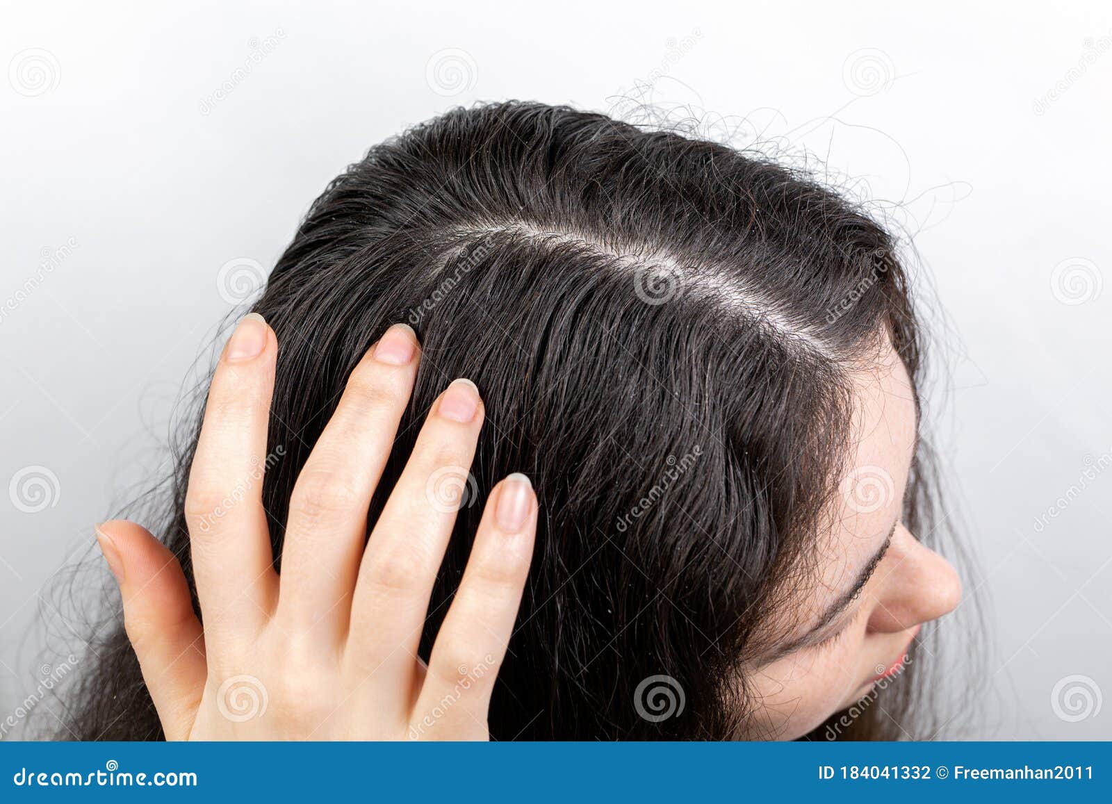 How to Remove Dandruff  Causes Signs and Treatments