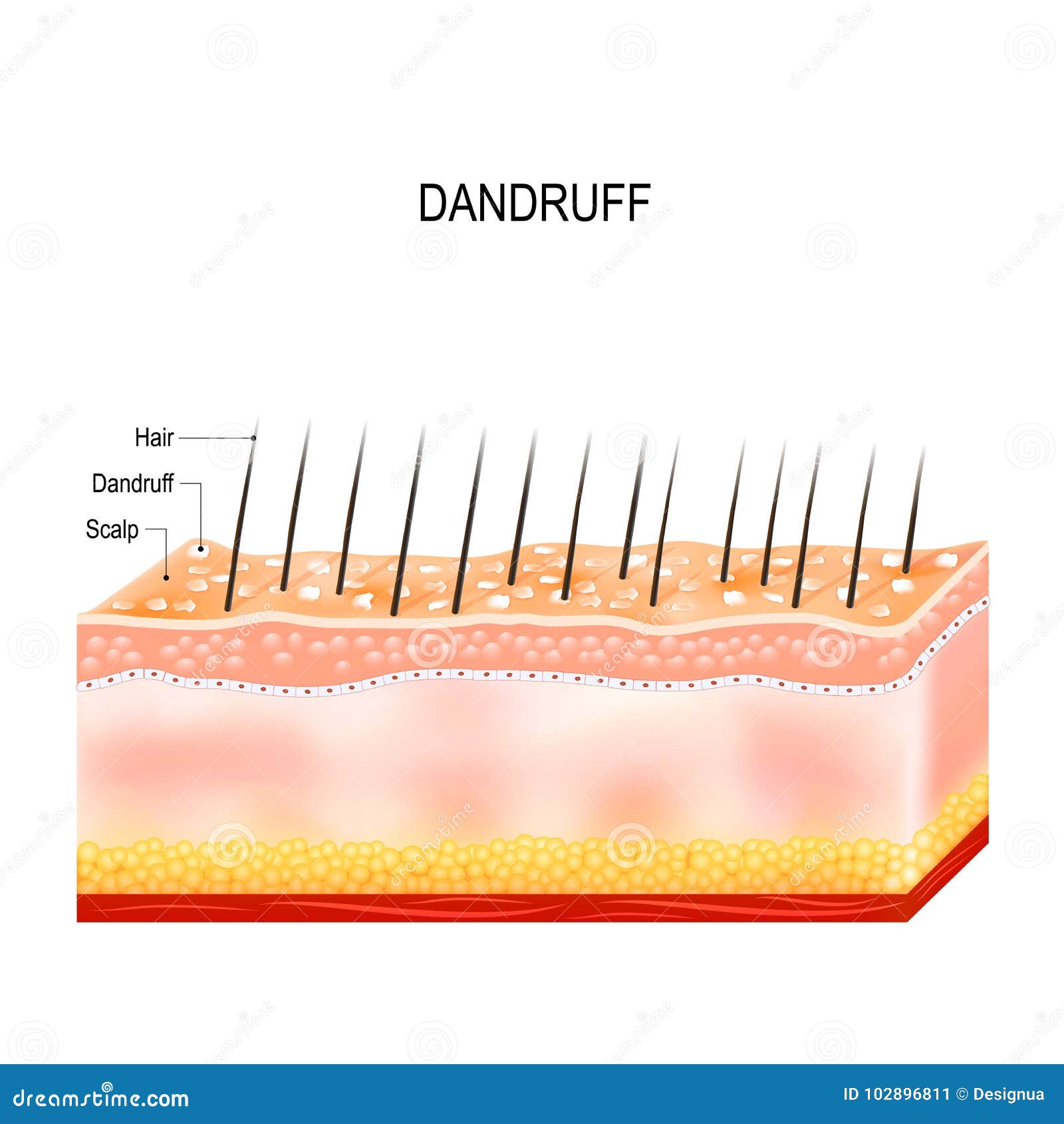 Dandruff on Hair Scalp. Disorders of the Scalp Stock Vector - Illustration  of closeup, fungus: 102896811