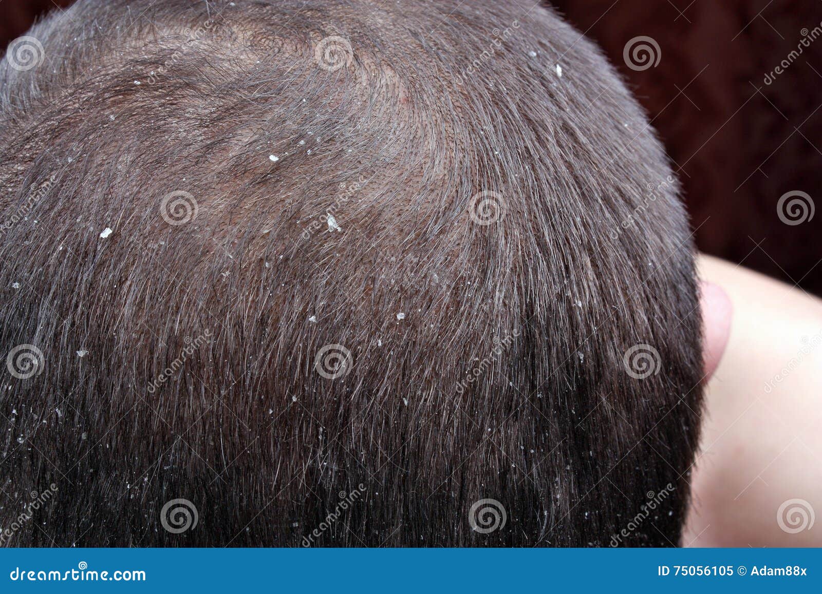 Dandruff In The Hair Stock Image Image Of Disease Problem 75056105
