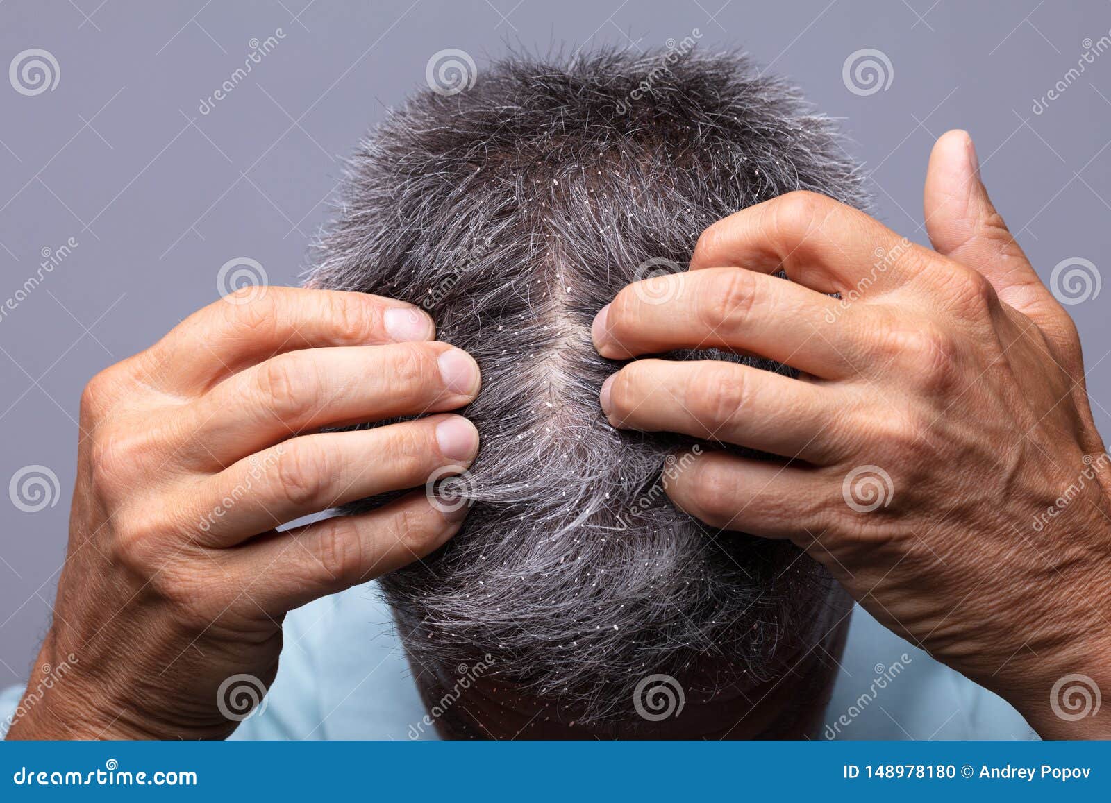 dandruff on man`s hair