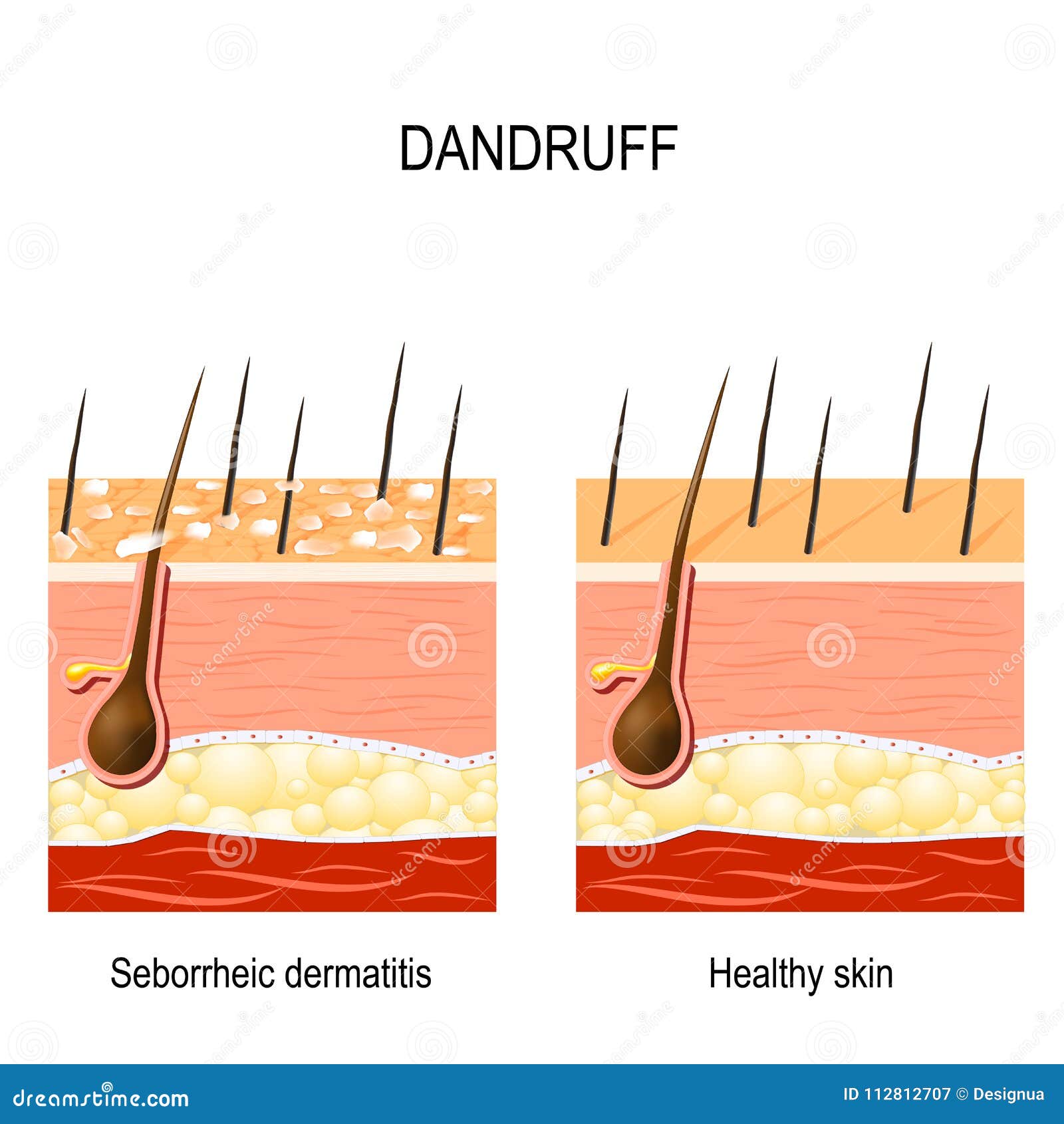 dandruff. seborrheic dermatitis