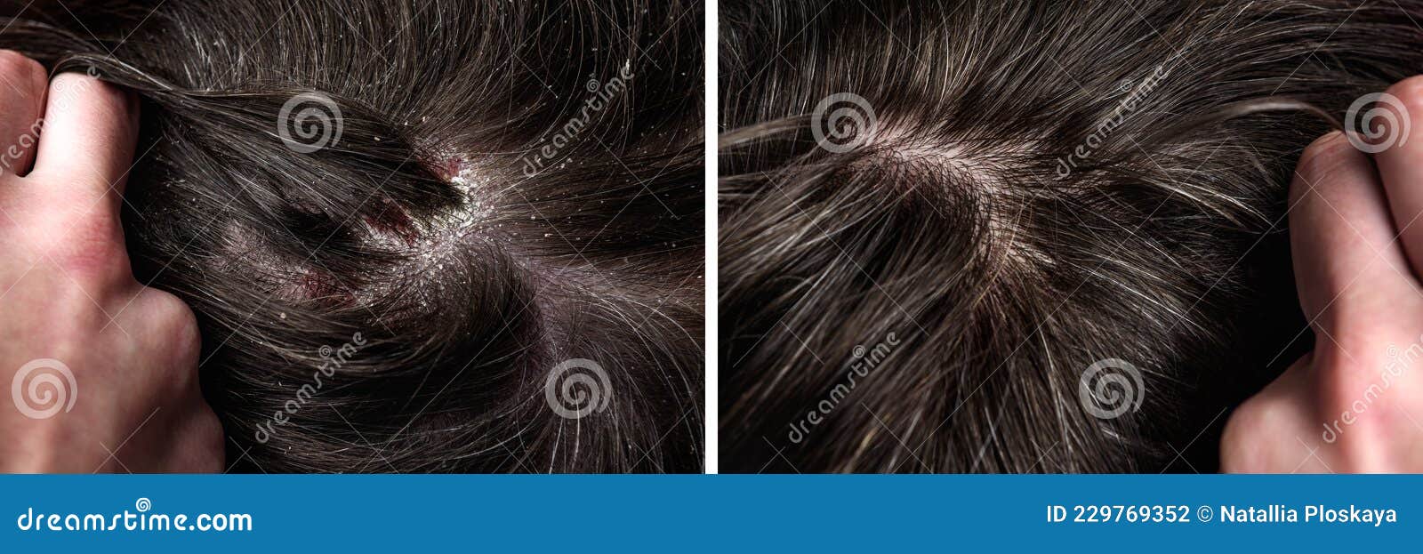 Flaky Scalp Stock Photos - Free & Royalty-Free Stock Photos from Dreamstime