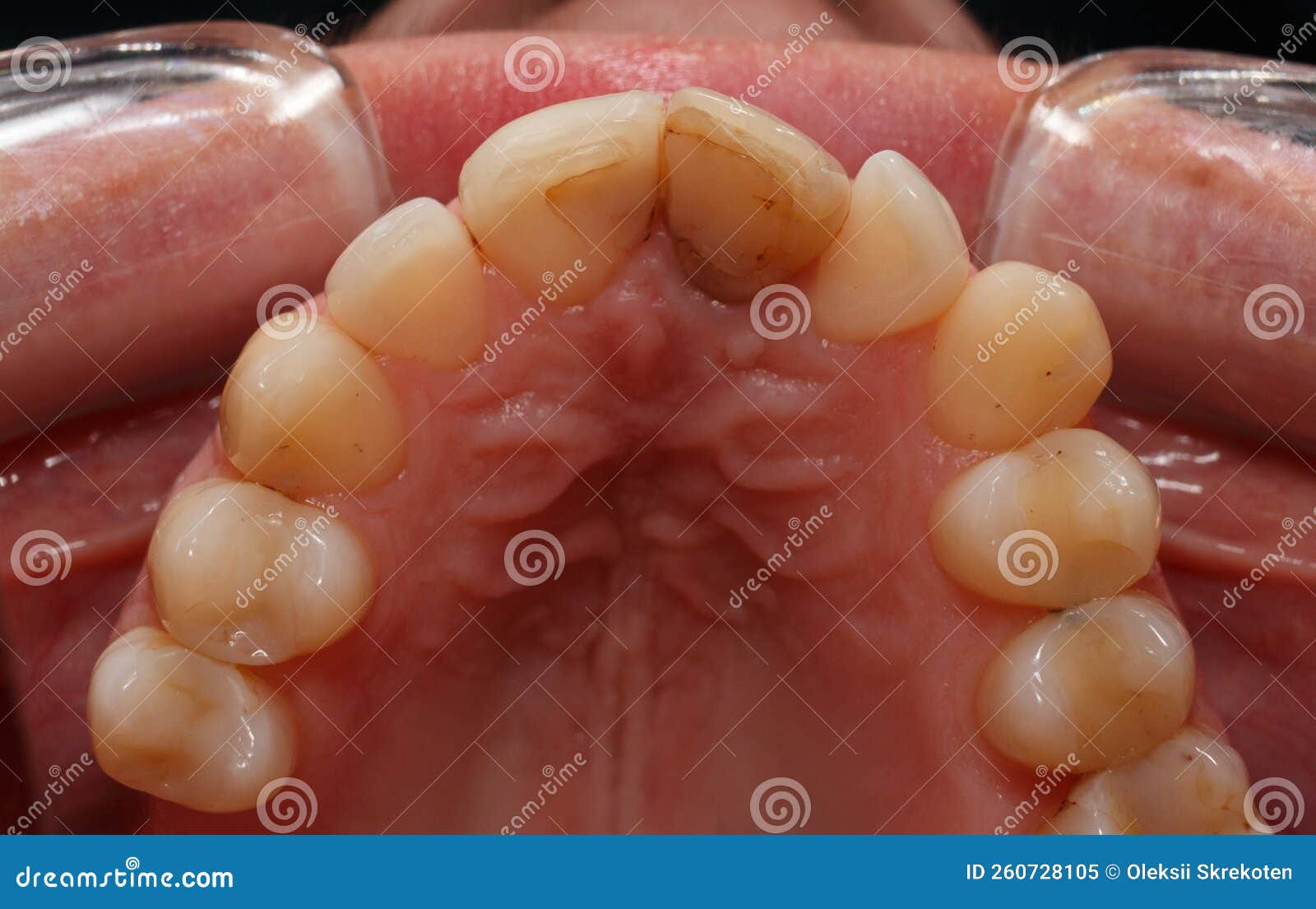 A Dark Front Tooth Protruding From The Tooth Row. A View Of The Teeth